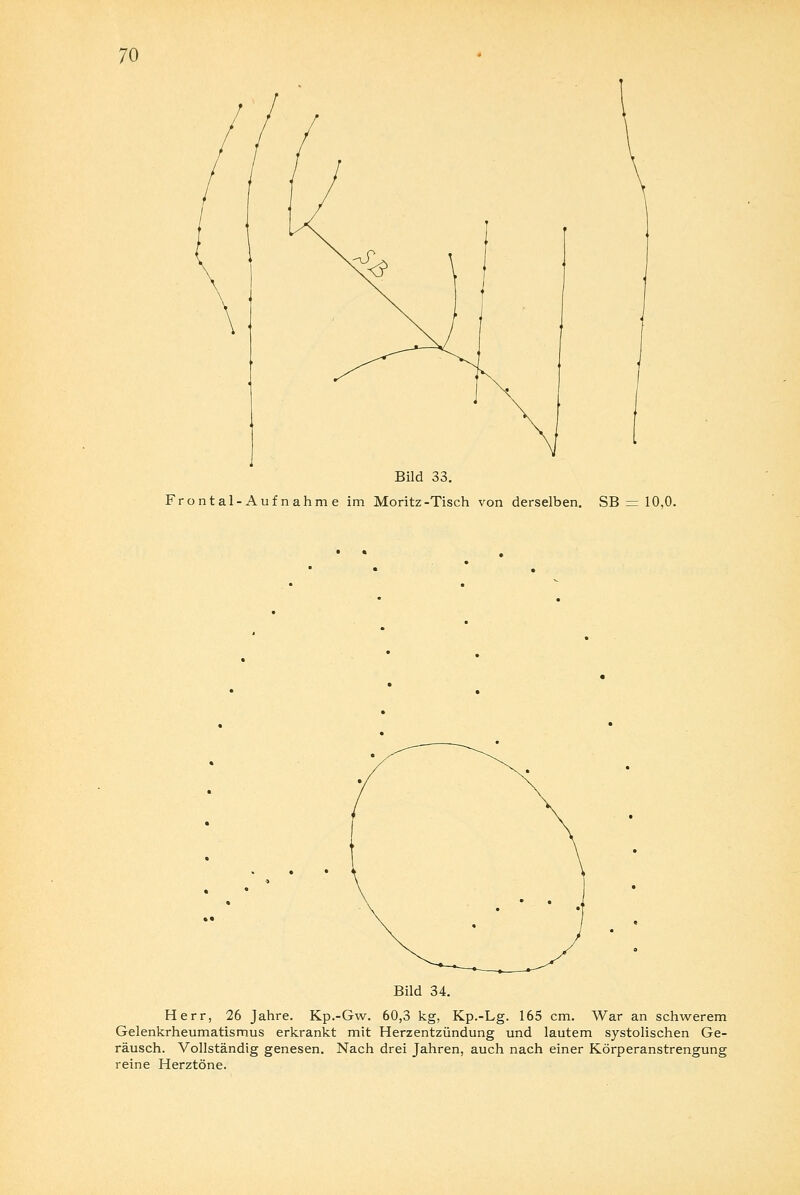 Bild 33. Frontal-Auf nahm e im Moritz-Tisch von derselben. SB = 10,0. Bild 34. Herr, 26 Jahre. Kp.-Gw. 60,3 kg, Kp.-Lg. 165 cm. War an schwerem Gelenkrheumatismus erkrankt mit Herzentzündung und lautem systolischen Ge- räusch. Vollständig genesen. Nach drei Jahren, auch nach einer Körperanstrengung reine Herztöne.