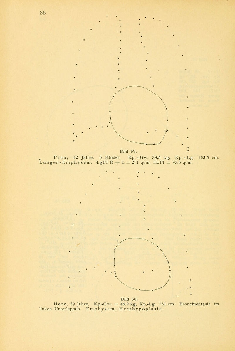 Bild 59. Frau, 42 Jahre, 6 Kinder. Kp. - Gw. 39,5 kg, Kp. - Lg. Lungen-Emphysem. Lg Fl R -|- L = 271 qcm, Hz Fl = 93,5 qcm. 153,5 cm. Bild 60. Herr, 39 Jahre. Kp.-Gw. = 45,9 kg, Kp.-Lg. 161 cm. linken Unterlappen. Emphysem. Herzhypoplasie. Bronchiektasie im