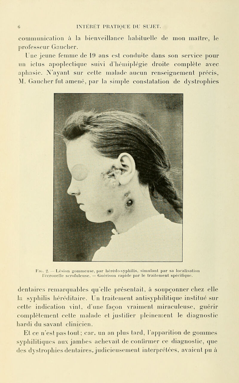 coaimiinication à la bienveillance habituelle de mon maître, le professeur Gaucher. Une jeune femme de 19 ans est contluile dans son service pour un ictus apoplectique suivi d'hémiplégie droite complète avec aphasie. N'ayant sur cette malade aucun renseignement précis, M. Gaucher fut amené, par la simple constatation de dystrophies FiG. 2. — Lésion gomineuse, par hérédo-syphilis, simulant par sa localisation rùcrouelle scrofuleuse. — Guérison lapide par le traitement spécifique. dentaires remarquables qu'elle présentait, à soupçonner chez elle la syphilis héréditaire. Un traitement antisyphilitique institué sur cette indication vint, d'une façon vraiment miraculeuse, guérir complètement cette malade et justifier pleinement le diagnostic hardi du savant clinicien. Et ce n'estpas tout; car, un an plus lard, l'apparition de gouuues syphilitiques aux jambes achevait de conlirmer ce diagnostic, que des dystrophiesdenlaires, judicioiiscmenl intcr[)rétées, avaient pu à