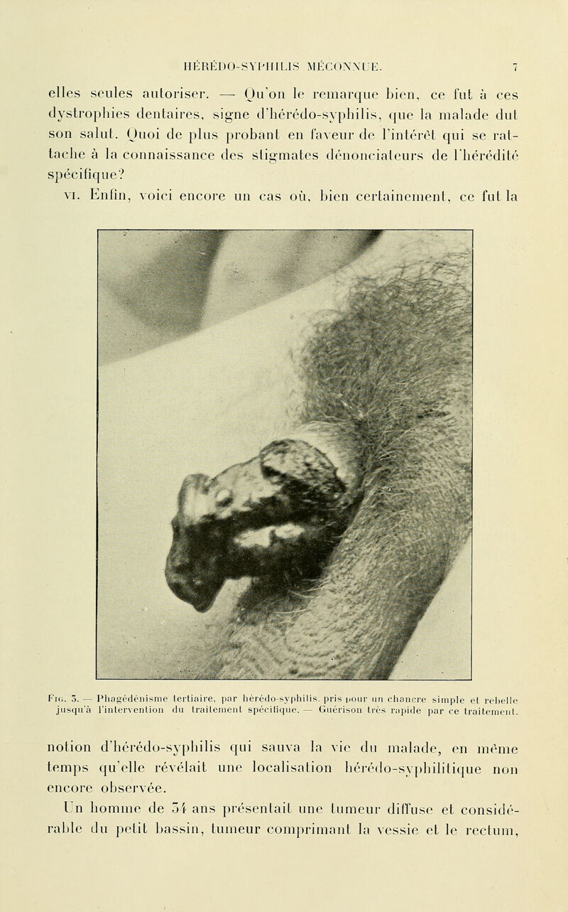 elles seules autoriser. — Qu'on le remarque bien, ce fut à ces dystrophies dentaires, signe d'hérédo-syphilis, que la malade dut son salut. Quoi de plus probant en faveur de l'intérêt qui se rat- tache à la connaissance des stigmates dénonciateurs de l'hérédité spécifique? VI. Enfin, voici encore un cas où, bien certainement, ce fut la FiG. 3. — Phagédéiiisme tertiaire, par hérédo-syphilis. pris ijour un ciiancre simple et reijeile jusqu'à l'intervention du traitement spécilique. — Guérison très rapide par ce traitement. notion d'hérédo-syphilis qui sauva la vie du malade, en même temps qu'elle révélait une localisation hérédo-syphilitique non encore observée. Un homme de 54 ans présentait une tumeur diffuse et considé- rable du petit bassin, tumeur comprimant la vessie et le rectum,