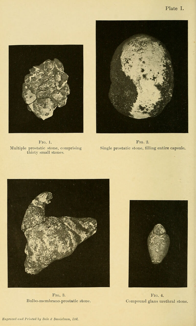 Plate I. Fig. 1. Multiple prostatic stone, comprising thirty small stones. Fig. 2. Single prostatic stone, rilling entire capsule. Fig. 3. Bulbo-membrano-prostatic stone. Fig. 4. Compound glans urethral stone. Engraved and Printed by Bale & Danielsson, Ltd.