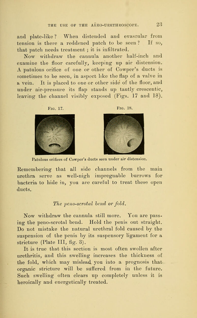 and plate-like ? When distended and evascular from tension is there a reddened patch to be seen ? If so, that patch needs treatment ; it is infiltrated. Now withdraw the cannula another half-inch and examine the floor carefully, keeping up air distension. A patulous orifice of one or other of Cowper's ducts is sometimes to be seen, in aspect like the flap of a valve in a vein. It is placed to one or other side of the floor, and under air-pressure its flap stands up tautly crescentic, leaving the channel visibly exposed (Figs. 17 and 18). Fig. 17. Fig. 18. Patulous orifices of Cowper's ducts seen under air distension. Remembering that all side channels from the main urethra serve as well-nigh impregnable burrows for bacteria to hide in, you are careful to treat these open ducts. The penoscrotal bend or fold. Now withdraw the cannula still more. You are pass- ing the peno-scrotal bend. Hold the penis out straight. Do not mistake the natural urethral fold caused by the suspension of the penis by its suspensory ligament for a stricture (Plate III, fig. 3). It is true that this section is most often swollen after urethritis, and this swelling increases the thickness of the fold, which may mislead you into a prognosis that organic stricture will be suffered from in the future. Such swelling often clears up completely unless it is heroically and energetically treated.
