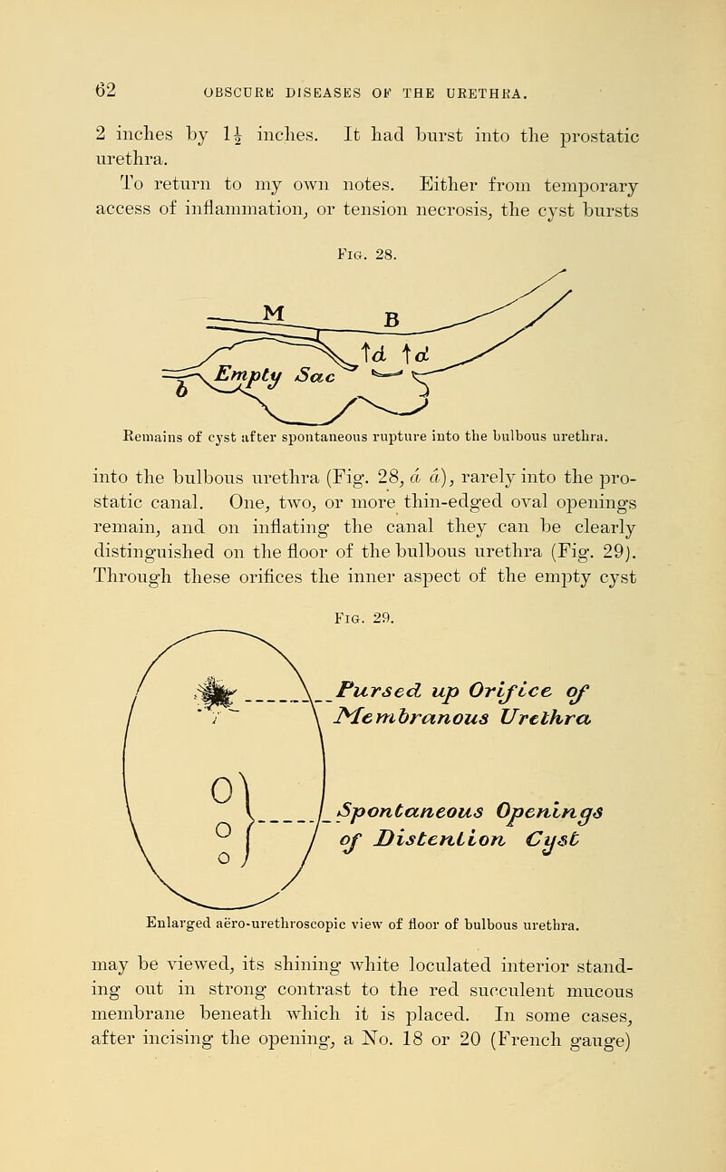 2 inches by 1| inches. It had burst into the prostatic urethra. To return to my own notes. Either from temporary access of inflammation, or tension necrosis, the cyst bursts Fig. 28. Remains of cyst niter spontaneous rupture into the bulbous urethra. into the bulbous urethra (Fig. 28, a a), rarely into the pro- static canal. One, two, or more thin-edged oval openings remain, and on inflating the canal they can be clearly distinguished on the floor of the bulbous urethra (Fig. 29). Through these orifices the inner aspect of the empty cyst Fig. 29. Pursed up Orifice of Membranous Urethra _ Spontaneous Openings of Distention Cyst Enlarged aero-urethroscopic view of floor of bulbous urethra. may be viewed, its shining white loculated interior stand- ing out in strong contrast to the red succulent mucous membrane beneath which it is placed. In some cases, after incising the opening, a jSTo. 18 or 20 (French gauge)