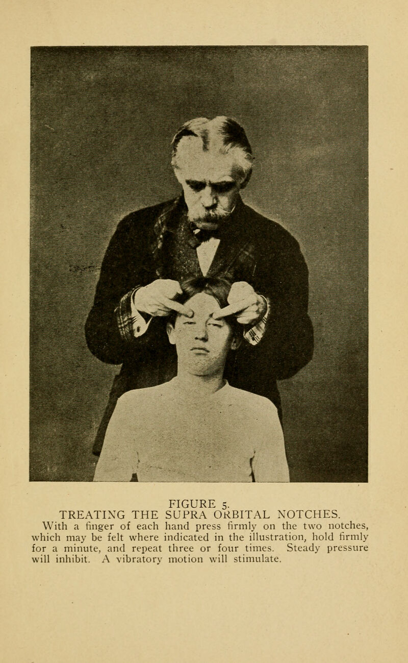 TREATING THE SUPRA ORBITAL NOTCHES. With a finger of each hand press firmly on the two notches, which may be felt where indicated in the illustration, hold firmly for a minute, and repeat three or four times. Steady pressure will inhibit. A vibratory motion will stimulate.