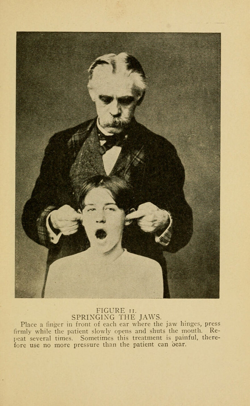 SPRINGING THE JAWS. Place a linger in front of each ear where the jaw hinges, press firmly while the patient slowly opens and shuts the mouth. Re- peat several times. Sometimes this treatment is^ painful, there- fore use no more pressure than the patient can bear.