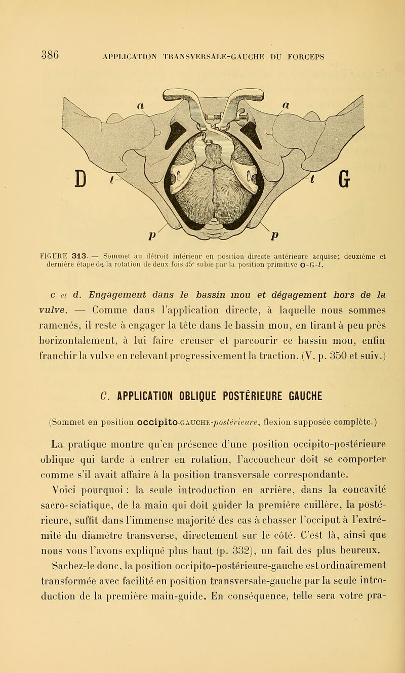 FIGURE 313. — Sommet au détroit intérieur en position directe antérieure acquise; deuxième et dernière étape de la rotation de deux fois 45 subie par la position primitive o-G-l. c cl d. Engagement dans le bassin mou et dégagement hors de la vulve. — Comme dans l'application directe, à laquelle nous sommes ramenés, il reste à engager la tête dans le bassin mou, en tirant à peu près horizontalement, à lui faire creuser et parcourir ce bassin mou, enfin l'ranchir la vulve en relevant progressivement la traction. (V. p. 350 et suiv.) C. APPLICATION OBLIQUE POSTÉRIEURE GAUCHE (Sommet en posilion occipito-GAUCHi';-/jos;é/tei(re, flexion supposée complète.) La pratique montre qu'en présence d'une position occipito-postérieure oblique qui tarde à entrer en rotation, l'accoucheur doit se comporter comme s'il avait affaire à la position transversale correspondante. Voici pourquoi : la seule introduction en arrière, dans la concavité sacro-sciatique, de la main qui doit guider la première cuillère, la posté- rieure, suffit dans l'immense majorité des cas à chasser l'occiput à l'extré- mité du diamètre transverse, directement sur le côté. C'est là, ainsi que nous vous l'avons expliqué plus haut (p. 332), un fait des plus heureux. Sachez-le donc, la position occipito-postérieure-gauche est ordinairement transformée avec facilité en position transversale-gauche par la seule intro- duction de la première main-guide. En conséquence, telle sera votre pra-