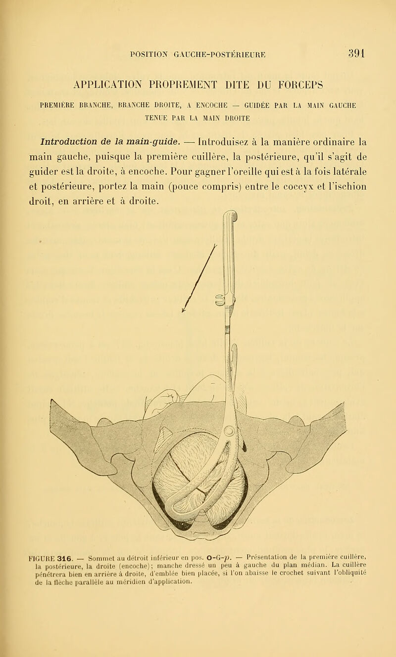 APPLICATION PROPREMENT DITE DU FORCEPS PREMIÈRE BHAN'CHE, BRANCHE DROITE, A ENCOCHE — GUIDÉE PAR LA MAIN GAUCHE TENUE PAR LA MALN DROITE Introduction de la main-guide. — Introduisez à la manière ordinaire la main gauche, puisque la première cuillère, la postérieure, qu'il s'agit de guider est la droite, à encoche. Pour gagner l'oreille qui est à la fois latérale et postérieure, portez la main (pouce compris) entre le coccyx et l'ischion droit, en arrière et à droite. I FIGURE 316. — Sommet au délroit inférieui' en pos. 0-G-;j. — Préseatation de la première cuillère, la postérieure, la droite (encoche); manche dressé un peu à gauche du plan médian. La cuillère pénétrera bien en arrière à droite, d'emblée bien placée, si l'on abaisse le crochet suivant l'obliquité de la ilechu parallèle au méridien d'application.