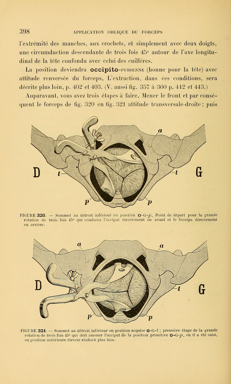 l'extrémité des manches, aux crochets, et simplement avec deux doigts, une circumduction descendante de trois fois 45° autour de l'axe longitu- dinal de la tète confondu avec celui des cuillères. La position deviendra occipito-PUBiENNE (bonne pour la tète) avec attitude renversée du forceps. L'extraction, dans ces conditions, sera décrite plus loin, p. 402 et 403. (V. aussi fig. 357 à 360 p. 442 et 443.) Auparavant, vous avez trois étapes à faire. Mener le front et par consé- quent le forceps de fig. 320 en fig. 321 atlilude Iransversale-droite ; puis FIGURE 320. — Sommet <ui détroit inférieur en position O-G-p. Point de départ pour la grande rotation de trois fois 45° qui conduira l'occiput directement en avant et le foiceps directeme'nt en arrière. FIGURE 321. — Sommet au détroit inférieur en position acquise 0-G-t ; première étape de la grande rotation de trois fois 45» qui doit amener l'occiput de la position primitive O-G-p, où il a été saisi, en position antérieure directe réalisée plus loin.