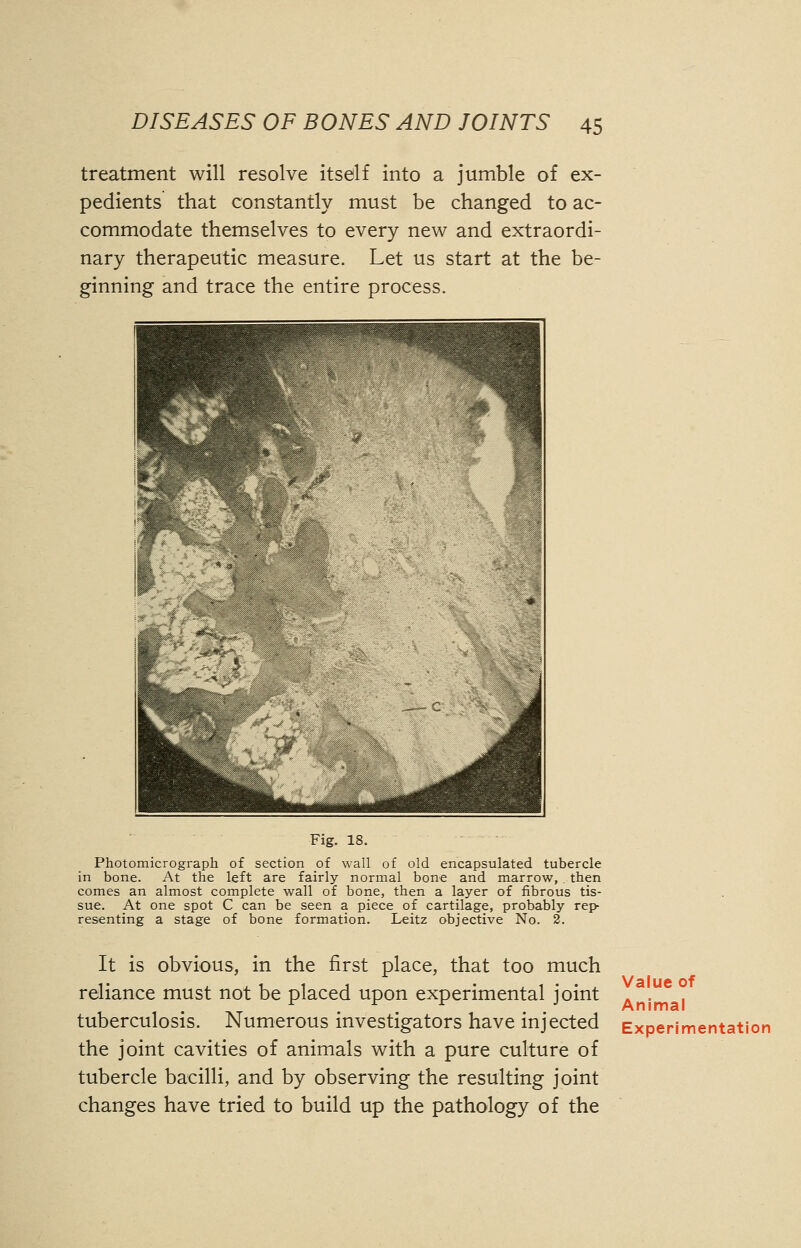 treatment will resolve itself into a jumble of ex- pedients that constantly must be changed to ac- commodate themselves to every new and extraordi- nary therapeutic measure. Let us start at the be- ginning and trace the entire process. Fig. 18. Photomicrograph of section of wall of old encapsulated tubercle in bone. At the left are fairly normal bone and marrow,. then comes an almost complete wall of bone, then a layer of fibrous tis- sue. At one spot C can be seen a piece of cartilage, probably rep- resenting a stage of bone formation. Leitz objective No. 2. It is obvious, in the first place, that too much reliance must not be placed upon experimental joint tuberculosis. Numerous investigators have injected the joint cavities of animals with a pure culture of tubercle bacilli, and by observing the resulting joint changes have tried to build up the pathology of the Value of Animal Experimentation