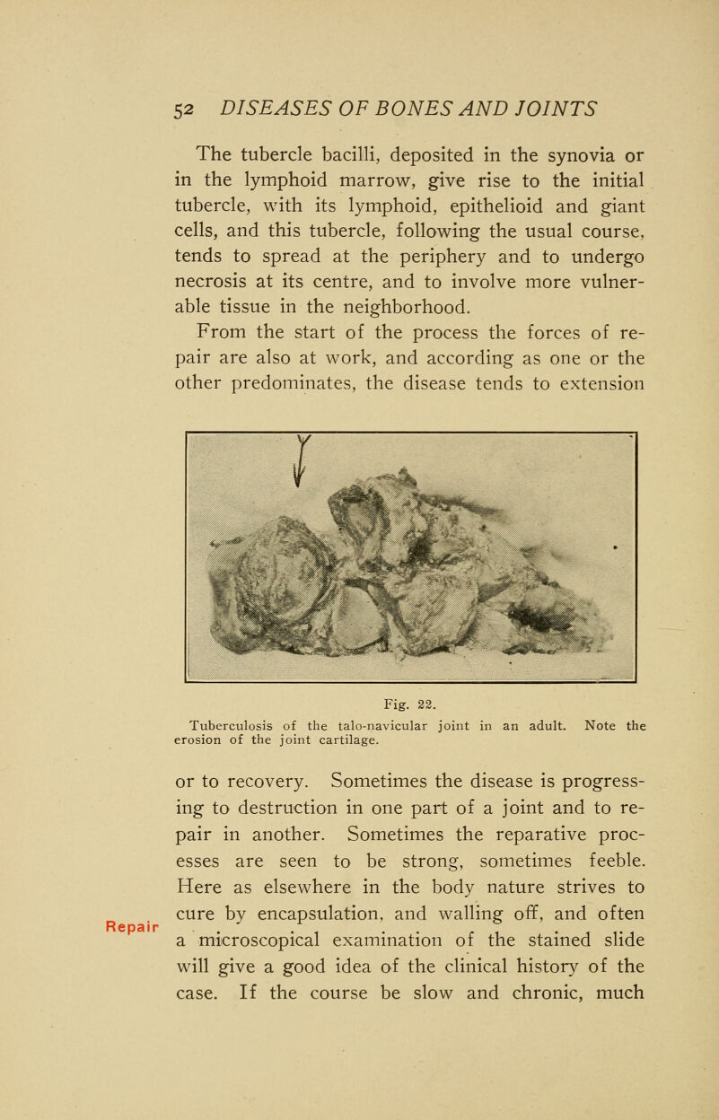 The tubercle bacilli, deposited in the synovia or in the lymphoid marrow, give rise to the initial tubercle, with its lymphoid, epithelioid and giant cells, and this tubercle, following the usual course, tends to spread at the periphery and to undergo necrosis at its centre, and to involve more vulner- able tissue in the neighborhood. From the start of the process the forces of re- pair are also at work, and according as one or the other predominates, the disease tends to extension Repair Fig. 22. Tuberculosis of the talo-navicular joint in an adult. Note the erosion of the joint cartilage. or to recovery. Sometimes the disease is progress- ing to destruction in one part of a joint and to re- pair in another. Sometimes the reparative proc- esses are seen to be strong, sometimes feeble. Here as elsewhere in the body nature strives to cure by encapsulation, and walling off, and often a microscopical examination of the stained slide will give a good idea of the clinical history of the case. If the course be slow and chronic, much