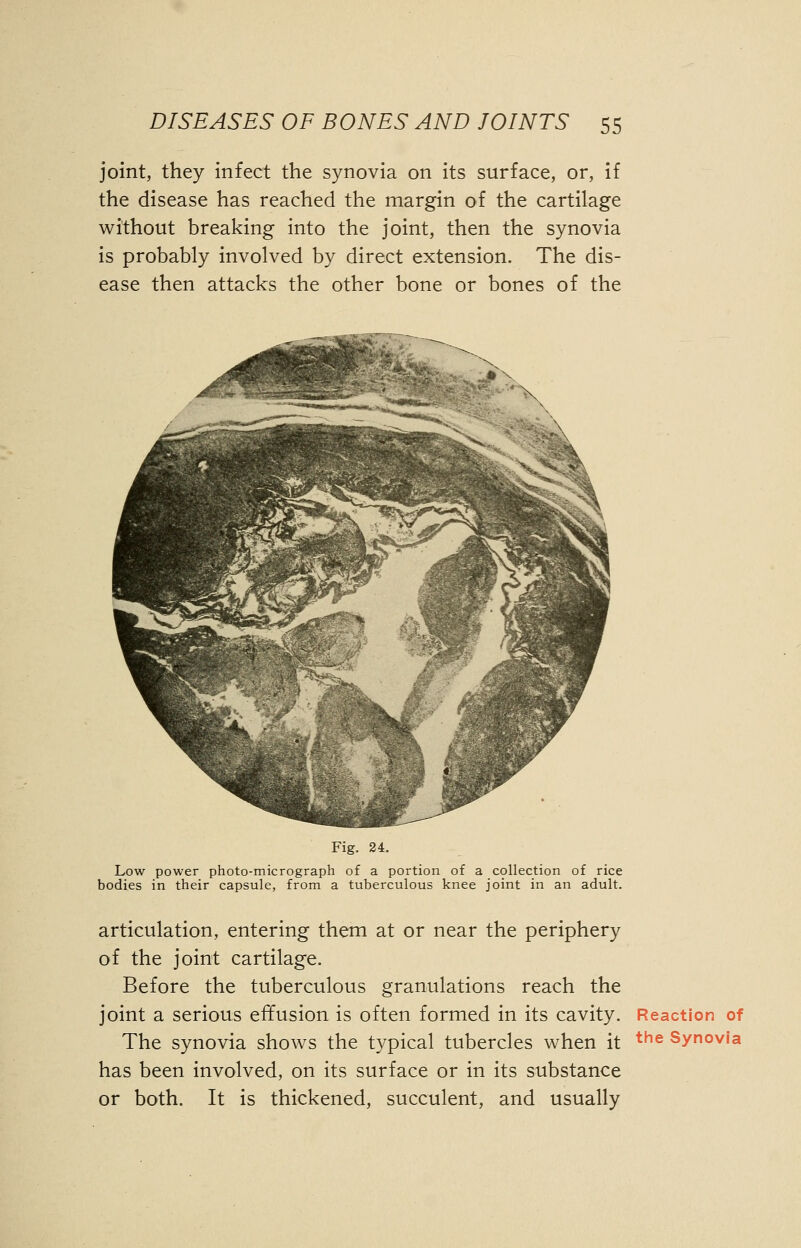 joint, they infect the synovia on its surface, or, if the disease has reached the margin of the cartilage without breaking into the joint, then the synovia is probably involved by direct extension. The dis- ease then attacks the other bone or bones of the Fig. 24. Low power photo-micrograph of a portion of a collection of rice bodies in their capsule, from a tuberculous knee joint in an adult. articulation, entering them at or near the periphery of the joint cartilage. Before the tuberculous granulations reach the joint a serious effusion is often formed in its cavity. Reaction of The synovia shows the typical tubercles when it the syn°via has been involved, on its surface or in its substance or both. It is thickened, succulent, and usually