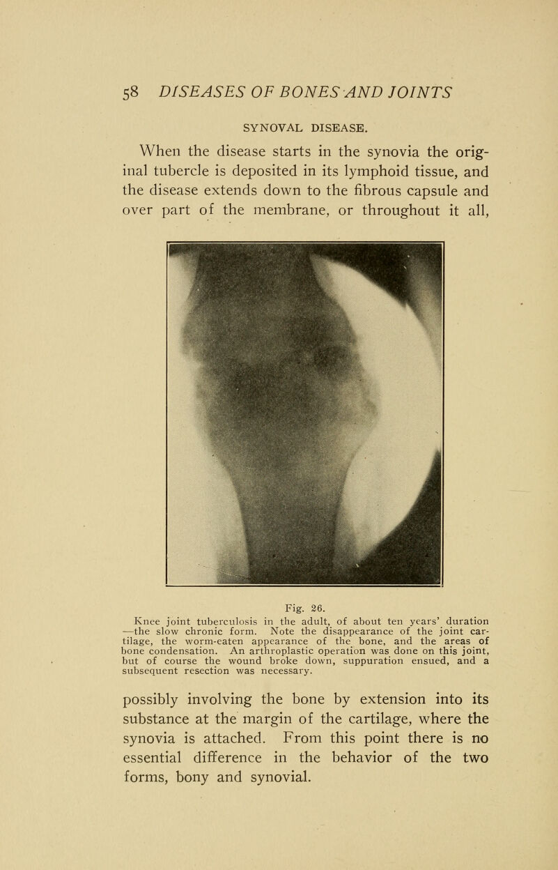 SYNOVAL DISEASE. When the disease starts in the synovia the orig- inal tubercle is deposited in its lymphoid tissue, and the disease extends down to the fibrous capsule and over part of the membrane, or throughout it all, Fig. 26. Knee joint tuberculosis in the adult, of about ten years' duration —the slow chronic form. Note the disappearance of the joint car- tilage, the worm-eaten appearance of the bone, and the areas of bone condensation. An arthroplasty operation was done on this joint, but of course the wound broke down, suppuration ensued, and a subsequent resection was necessary. possibly involving the bone by extension into its substance at the margin of the cartilage, where the synovia is attached. From this point there is no essential difference in the behavior of the two forms, bony and synovial.