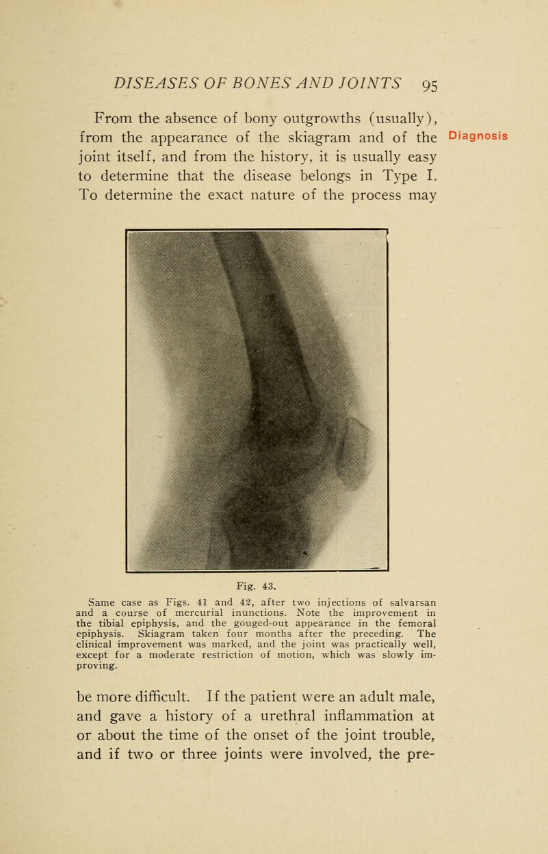 From the absence of bony outgrowths (usually), from the appearance of the skiagram and of the Diagnosis joint itself, and from the history, it is usually easy to determine that the disease belongs in Type I. To determine the exact nature of the process may Fig. 43. Same case as Figs. 41 and 42, after two injections of salvarsan and a course of mercurial inunctions. Note the improvement in the tibial epiphysis, and the gouged-out appearance in the femoral epiphysis. Skiagram taken four months after the preceding. The clinical improvement was marked, and the joint was practically well, except for a moderate restriction of motion, which was slowly im- proving. be more difficult. If the patient were an adult male, and gave a history of a urethral inflammation at or about the time of the onset of the joint trouble, and if two or three joints were involved, the pre-