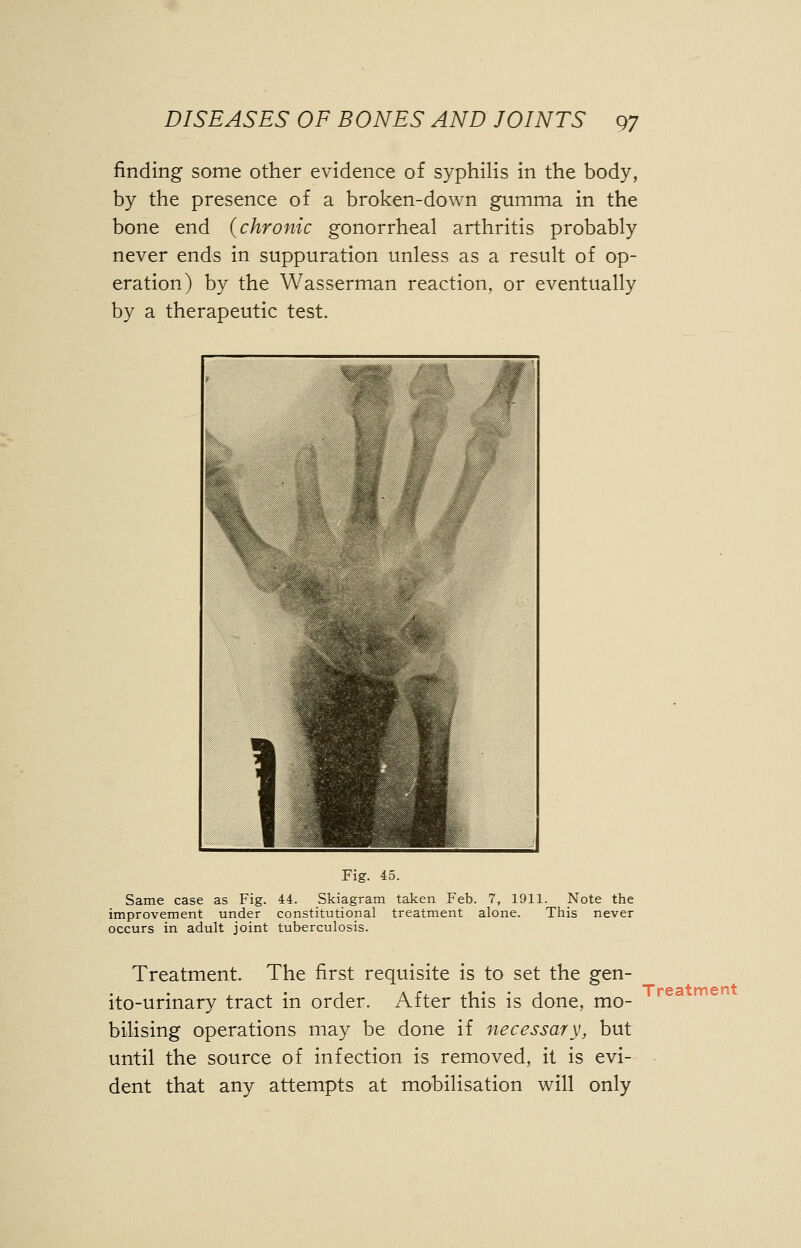 finding some other evidence of syphilis in the body, by the presence of a broken-down gumma in the bone end {chronic gonorrheal arthritis probably never ends in suppuration unless as a result of op- eration) by the Wasserman reaction, or eventually by a therapeutic test. Fig. 45. Same case as Fig. 44. Skiagram taken Feb. 7, 1911. Note the improvement under constitutional treatment alone. This never occurs in adult joint tuberculosis. Treatment. The first requisite is to set the gen- ito-urinary tract in order. After this is done, mo- bilising operations may be done if necessary, but until the source of infection is removed, it is evi- dent that any attempts at mobilisation will only Treatment