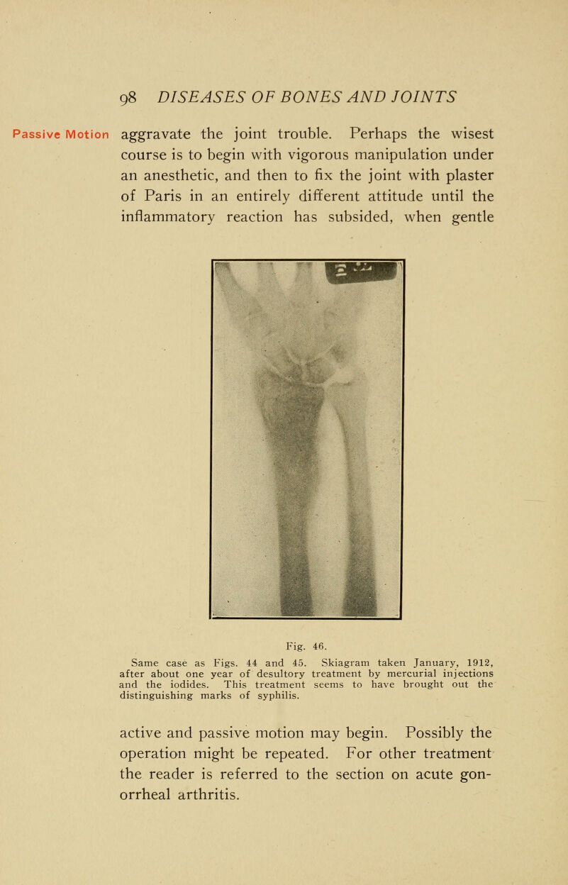 Passive Motion aggravate the joint trouble. Perhaps the wisest course is to begin with vigorous manipulation under an anesthetic, and then to fix the joint with plaster of Paris in an entirely different attitude until the inflammatory reaction has subsided, when gentle Fig. 46. Same case as Figs. 44 and 45. Skiagram taken January, 1912, after about one year of desultory treatment by mercurial injections and the iodides. This treatment seems to have brought out the' distinguishing marks of syphilis. active and passive motion may begin. Possibly the operation might be repeated. For other treatment the reader is referred to the section on acute gon- orrheal arthritis.