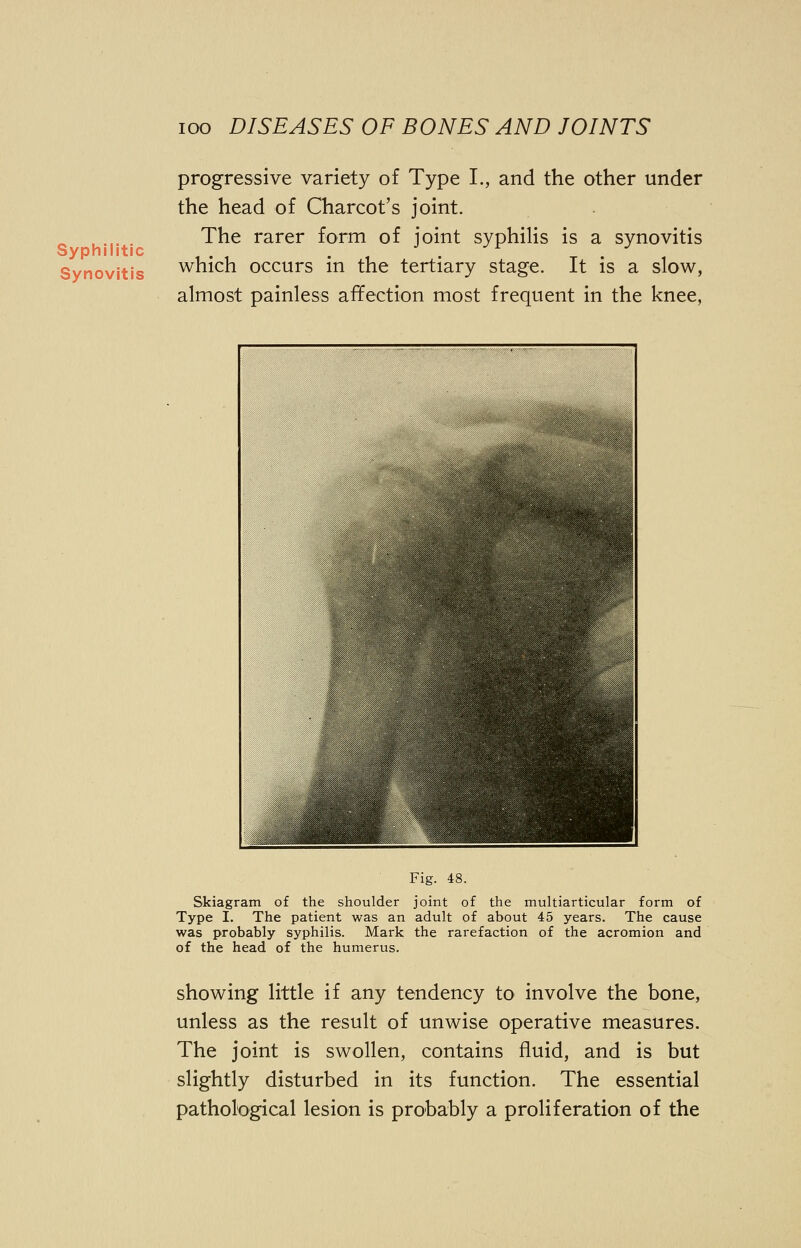 Syphilitic Synovitis progressive variety of Type I., and the other under the head of Charcot's joint. The rarer form of joint syphilis is a synovitis which occurs in the tertiary stage. It is a slow, almost painless affection most frequent in the knee, Fig. 48. Skiagram of the shoulder joint of the multiarticular form of Type I. The patient was an adult of about 45 years. The cause was probably syphilis. Mark the rarefaction of the acromion and of the head of the humerus. showing little if any tendency to involve the bone, unless as the result of unwise operative measures. The joint is swollen, contains fluid, and is but slightly disturbed in its function. The essential pathological lesion is probably a proliferation of the