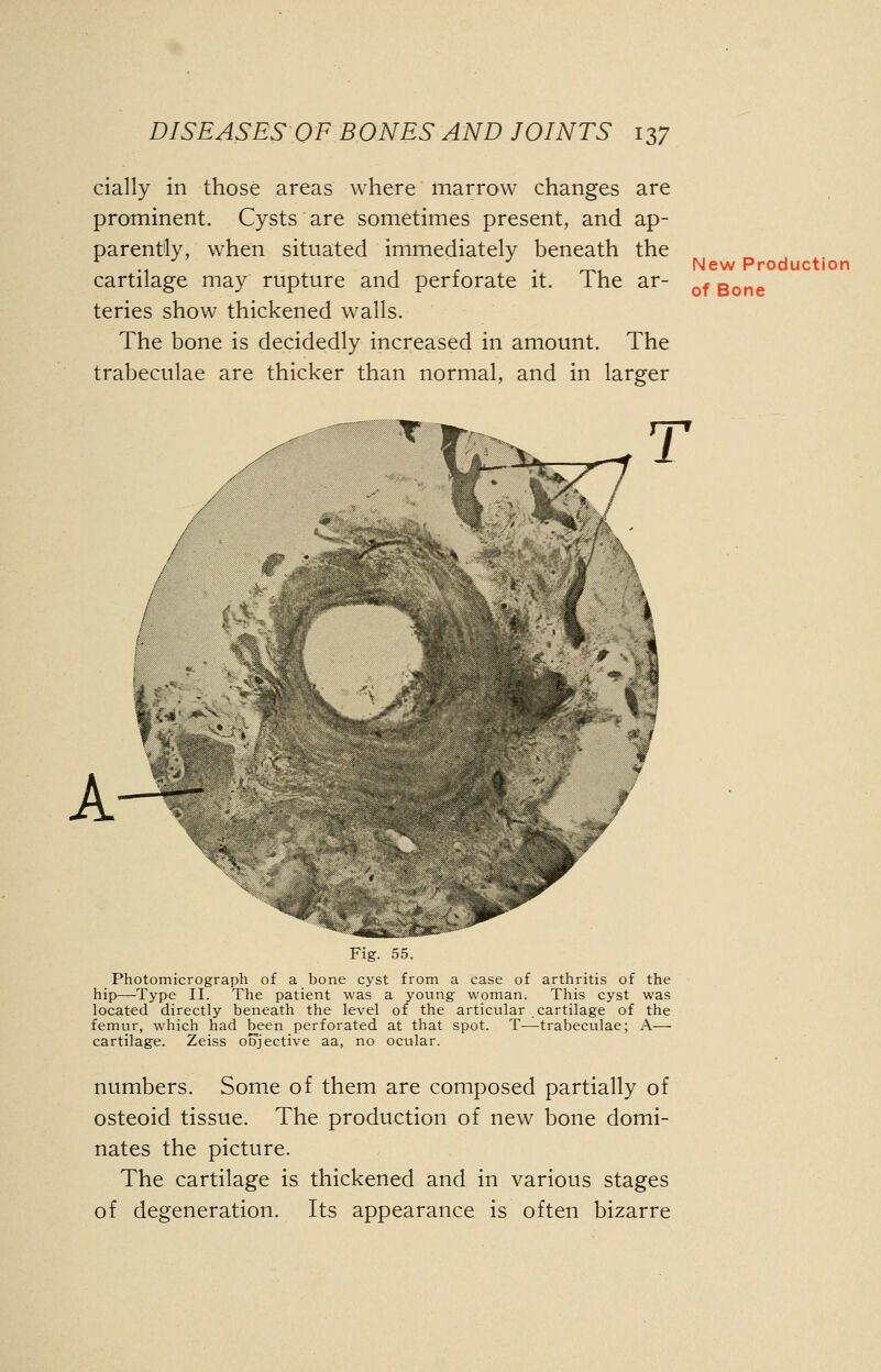 daily in those areas where marrow changes are prominent. Cysts are sometimes present, and ap- parently, when situated immediately beneath the cartilage may rupture and perforate it. The ar- teries show thickened walls. The bone is decidedly increased in amount. The trabeculae are thicker than normal, and in larger New Production of Bone Fig. 55. Photomicrograph of a bone cyst from a case of arthritis of the hip—Type II. The patient was a young woman. This cyst was located directly beneath the level of the articular cartilage of the femur, which had been perforated at that spot. T—trabeculae; A— cartilage. Zeiss ofTjective aa, no ocular. numbers. Some of them are composed partially of osteoid tissue. The production of new bone domi- nates the picture. The cartilage is thickened and in various stages of degeneration. Its appearance is often bizarre