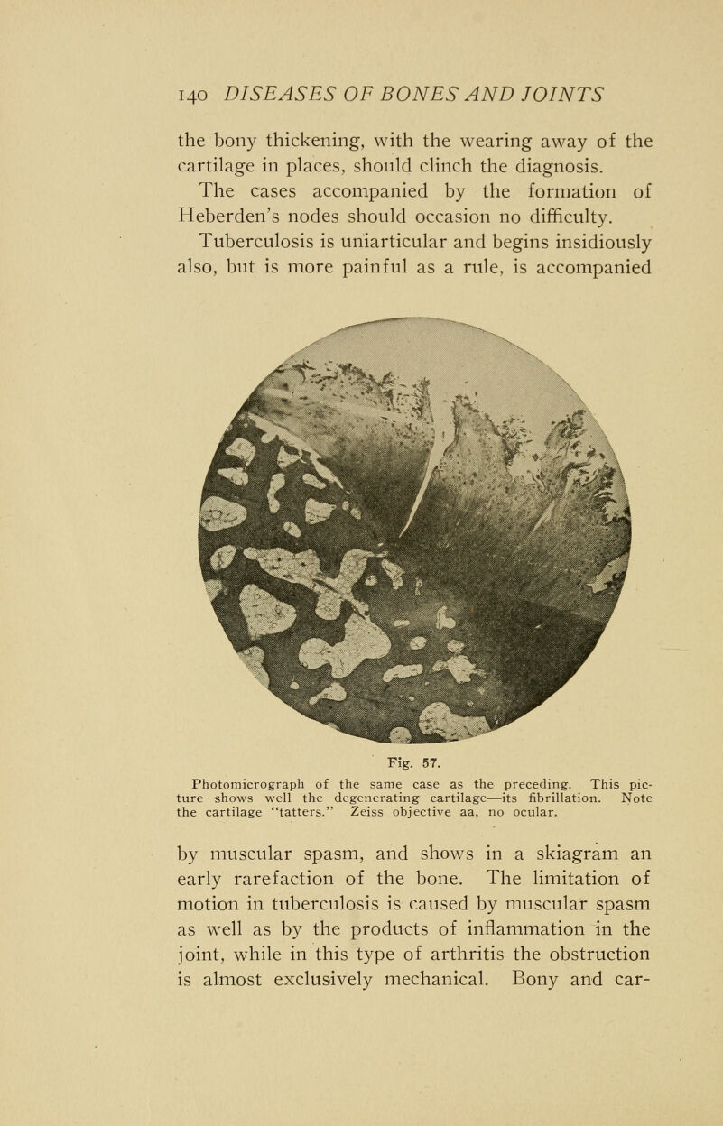 the bony thickening, with the wearing away of the cartilage in places, should clinch the diagnosis. The cases accompanied by the formation of Heberden's nodes should occasion no difficulty. Tuberculosis is uniarticular and begins insidiously also, but is more painful as a rule, is accompanied Fig. 57. Photomicrograph of the same case as the preceding. This pic- ture shows well the degenerating cartilage—its fibrillation. Note the cartilage tatters. Zeiss objective aa, no ocular. by muscular spasm, and shows in a skiagram an early rarefaction of the bone. The limitation of motion in tuberculosis is caused by muscular spasm as well as by the products of inflammation in the joint, while in this type of arthritis the obstruction is almost exclusively mechanical. Bony and car-