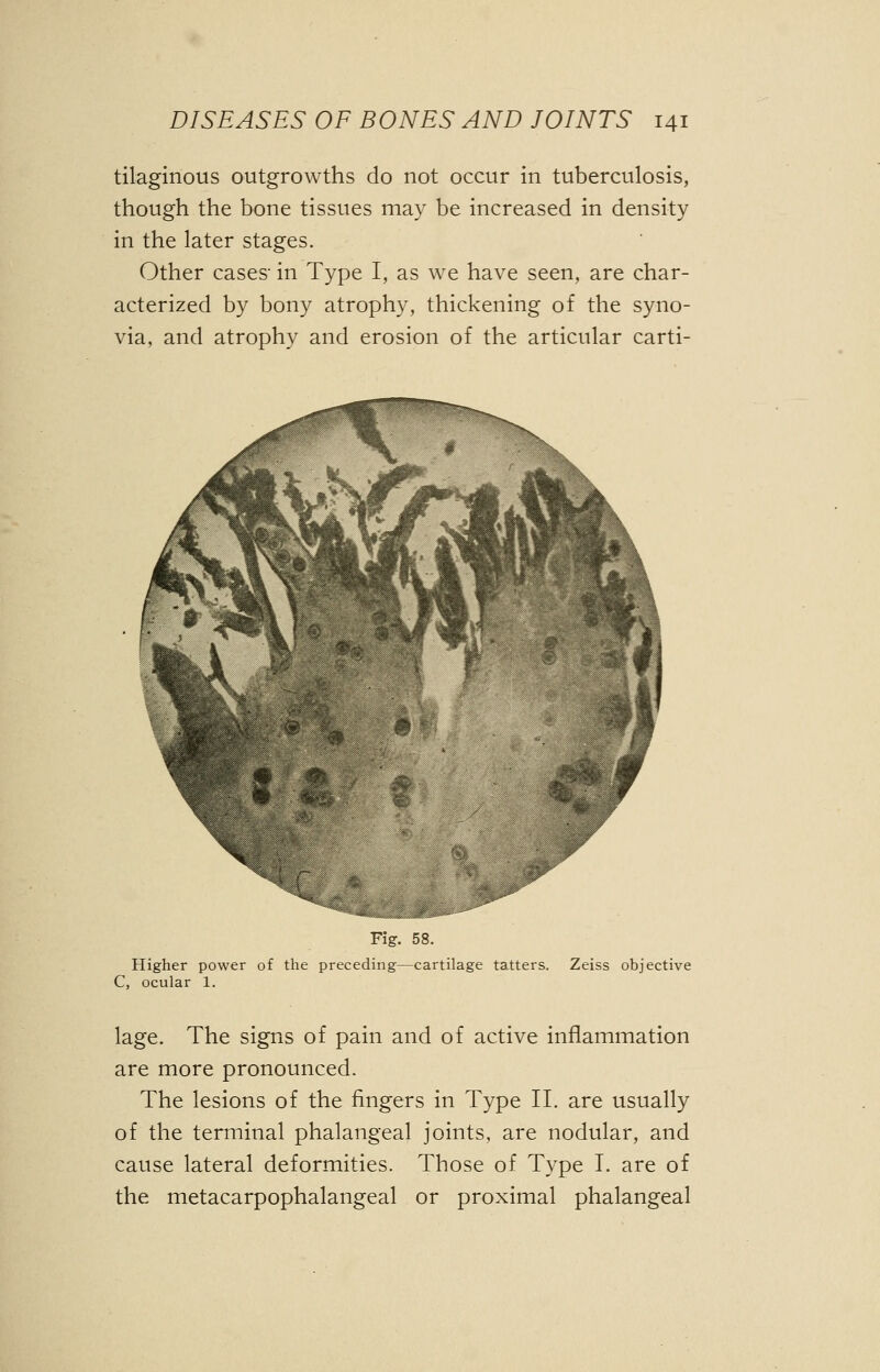 tilaginous outgrowths do not occur in tuberculosis, though the bone tissues may be increased in density in the later stages. Other cases- in Type I, as we have seen, are char- acterized by bony atrophy, thickening of the syno- via, and atrophy and erosion of the articular carti- Fig. 58. Higher power of the preceding—cartilage tatters. Zeiss objective C, ocular 1. lage. The signs of pain and of active inflammation are more pronounced. The lesions of the fingers in Type II. are usually of the terminal phalangeal joints, are nodular, and cause lateral deformities. Those of Type I. are of the metacarpophalangeal or proximal phalangeal