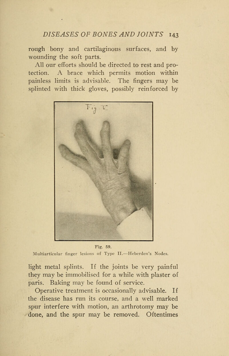 rough bony and cartilaginous surfaces, and by wounding the soft parts. All our efforts should be directed to rest and pro- tection. A brace which permits motion within painless limits is advisable. The fingers may be splinted with thick gloves, possibly reinforced by Fig. 59. Multiarticular finger lesions of Type II.—Heberden's Nodes. light metal splints. If the joints be very painful they may be immobilised for a while with plaster of paris. Baking may be found of service. Operative treatment is occasionally advisable. If the disease has run its course, and a well marked spur interfere with motion, an arthrotomy may be done, and the spur may be removed. Oftentimes