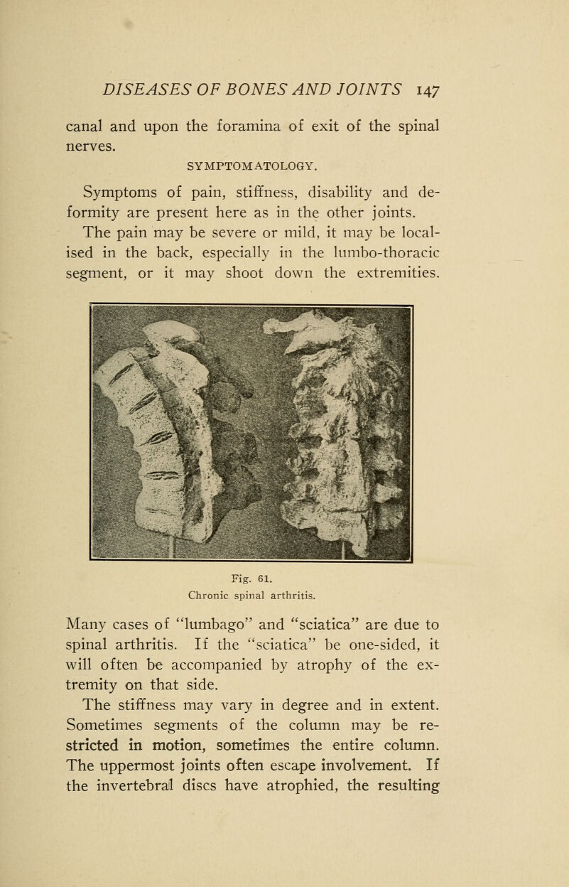 canal and upon the foramina of exit of the spinal nerves. SYMPTOMATOLOGY. Symptoms of pain, stiffness, disability and de- formity are present here as in the other joints. The pain may be severe or mild, it may be local- ised in the back, especially in the lumbo-thoracic segment, or it may shoot down the extremities. Fig. 61. Chronic spinal arthritis. Many cases of lumbago and sciatica are due to spinal arthritis. If the sciatica be one-sided, it will often be accompanied by atrophy of the ex- tremity on that side. The stiffness may vary in degree and in extent. Sometimes segments of the column may be re- stricted in motion, sometimes the entire column. The uppermost joints often escape involvement. If the invertebral discs have atrophied, the resulting