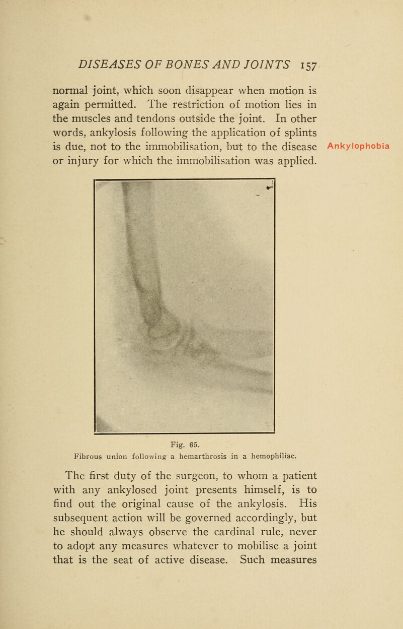 normal joint, which soon disappear when motion is again permitted. The restriction of motion lies in the muscles and tendons outside the joint. In other words, ankylosis following the application of splints is due, not to the immobilisation, but to the disease Ankyiophobia or injury for which the immobilisation was applied. Fig. 65. Fibrous union following a hemarthrosis in a hemophiliac. The first duty of the surgeon, to whom a patient with any ankylosed joint presents himself, is to find out the original cause of the ankylosis. His subsequent action will be governed accordingly, but he should always observe the cardinal rule, never to adopt any measures whatever to mobilise a joint that is the seat of active disease. Such measures