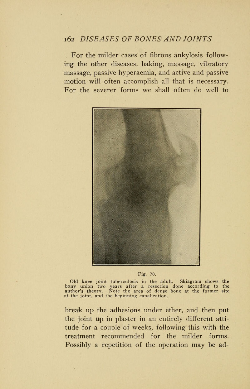 For the milder cases of fibrous ankylosis follow- ing the other diseases, baking, massage, vibratory massage, passive hyperaemia, and active and passive motion will often accomplish all that is necessary. For the severer forms we shall often do well to Fig. 70. Old knee joint tuberculosis in the adult. Skiagram shows the bony union two years after a resection done according to the author's theory. Note the area of dense bone at the former site of the joint, and the beginning canalization. break up the adhesions under ether, and then put the joint up in plaster in an entirely different atti- tude for a couple of weeks, following this with the treatment recommended for the milder forms. Possibly a repetition of the operation may be ad-