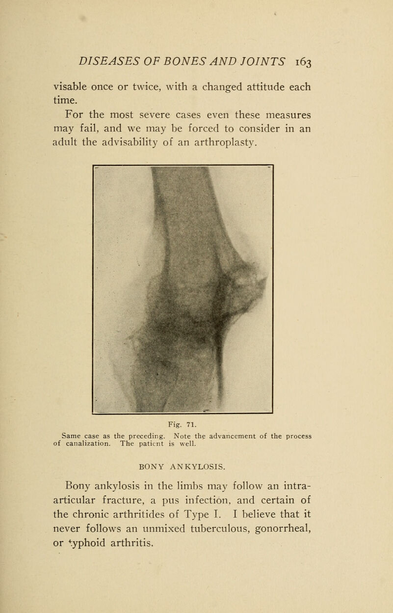 visable once or twice, with a changed attitude each time. For the most severe cases even these measures may fail, and we may be forced to consider in an adult the advisability of an arthroplasty. Fig. 71. Same case as the preceding. Note the advancement of the process of canalization. The patient is well. BONY ANKYLOSIS. Bony ankylosis in the limbs may follow an intra- articular fracture, a pus infection, and certain of the chronic arthritides of Type I. I believe that it never follows an unmixed tuberculous, gonorrheal, or typhoid arthritis.