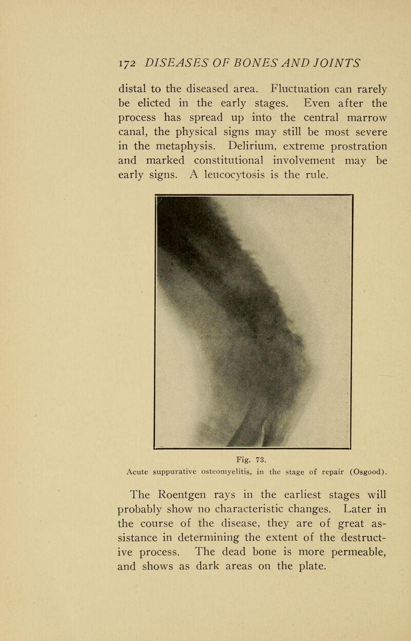 distal to the diseased area. Fluctuation can rarely be elicted in the early stages. Even after the process has spread up into the central marrow canal, the physical signs may still be most severe in the metaphysis. Delirium, extreme prostration and marked constitutional involvement may be early signs. A leucocytosis is the rule. Fig. 73. Acute suppurative osteomyelitis, in the stage of repair (Osgood). The Roentgen rays in the earliest stages will probably show no characteristic changes. Later in the course of the disease, they are of great as- sistance in determining the extent of the destruct- ive process. The dead bone is more permeable, and shows as dark areas on the plate.