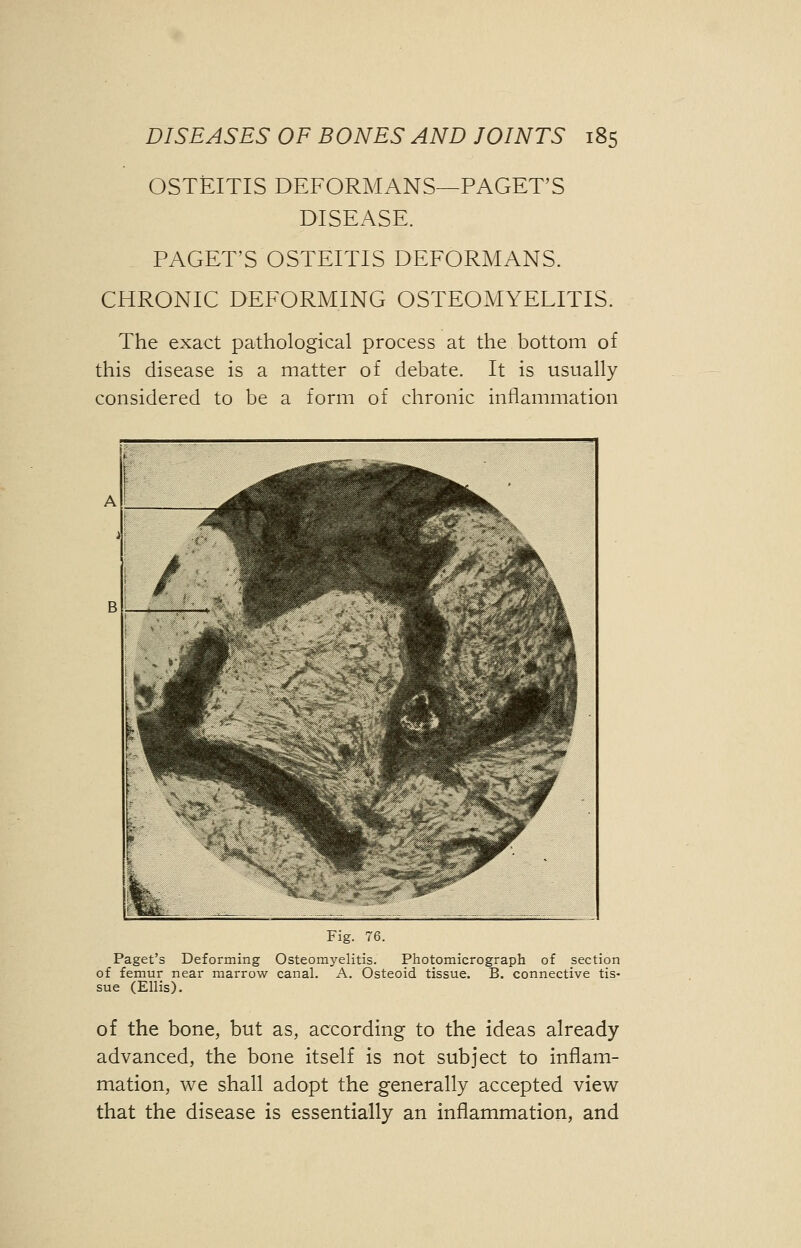 OSTEITIS DEFORMANS- DISEASE. -PAGET'S PAGET'S OSTEITIS DEFORMANS. CHRONIC DEFORMING OSTEOMYELITIS. The exact pathological process at the bottom of this disease is a matter of debate. It is usually considered to be a form of chronic inflammation Fig. 76. Paget's Deforming Osteomyelitis. Photomicrograph of section of femur near marrow canal. A. Osteoid tissue. B. connective tis- sue (Ellis). of the bone, but as, according to the ideas already advanced, the bone itself is not subject to inflam- mation, we shall adopt the generally accepted view that the disease is essentially an inflammation, and