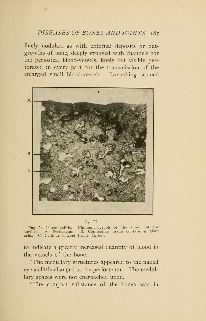 finely nodular, as with external deposits or out- growths of bone, deeply grooved with channels for the periosteal blood-vessels, finely but visibly per- forated in every part for the transmission of the enlarged small blood-vessels. Everything seemed Fig. 77. Paget's Osteomyelitis. Photomicrograph of the femur at the surface. A. Periosteum. B. Connective tissue containing giant cells. C. Cellular osteoid tissue (Ellis). to indicate a greatly increased quantity of blood in the vessels of the bone. The medullary structures appeared to the naked eye as little changed as the periosteum. The medul- lary spaces were not encroached upon. The compact substance of the bones was in