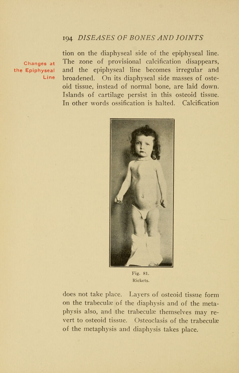 Changes at the Epiphyseal Line tion on the diaphyseal side of the epiphyseal line. The zone of provisional calcification disappears, and the epiphyseal line becomes irregular and broadened. On its diaphyseal side masses of oste- oid tissue, instead of normal bone, are laid down. Islands of cartilage persist in this osteoid tissue. In other words ossification is halted. Calcification Fig. 81. Rickets. does not take place. Layers of osteoid tissue form on the trabecular of the diaphysis and of the meta- physis also, and the trabecular themselves may re- vert to osteoid tissue. Osteoclasis of the trabecular of the metaphysis and diaphysis takes place.