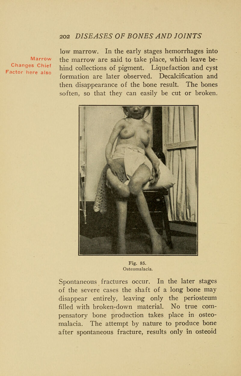 Marrow Changes Chief Factor here also low marrow. In the early stages hemorrhages into the marrow are said to take place, which leave be- hind collections of pigment. Liquefaction and cyst formation are later observed. Decalcification and then disappearance of the bone result. The bones soften, so that they can easily be cut or broken. Fig. 85. Osteomalacia. Spontaneous fractures occur. In the later stages of the severe cases the shaft of a long bone may disappear entirely, leaving only the periosteum filled with broken-down material. No true com- pensatory bone production takes place in osteo- malacia. The attempt by nature to produce bone after spontaneous fracture, results only in osteoid