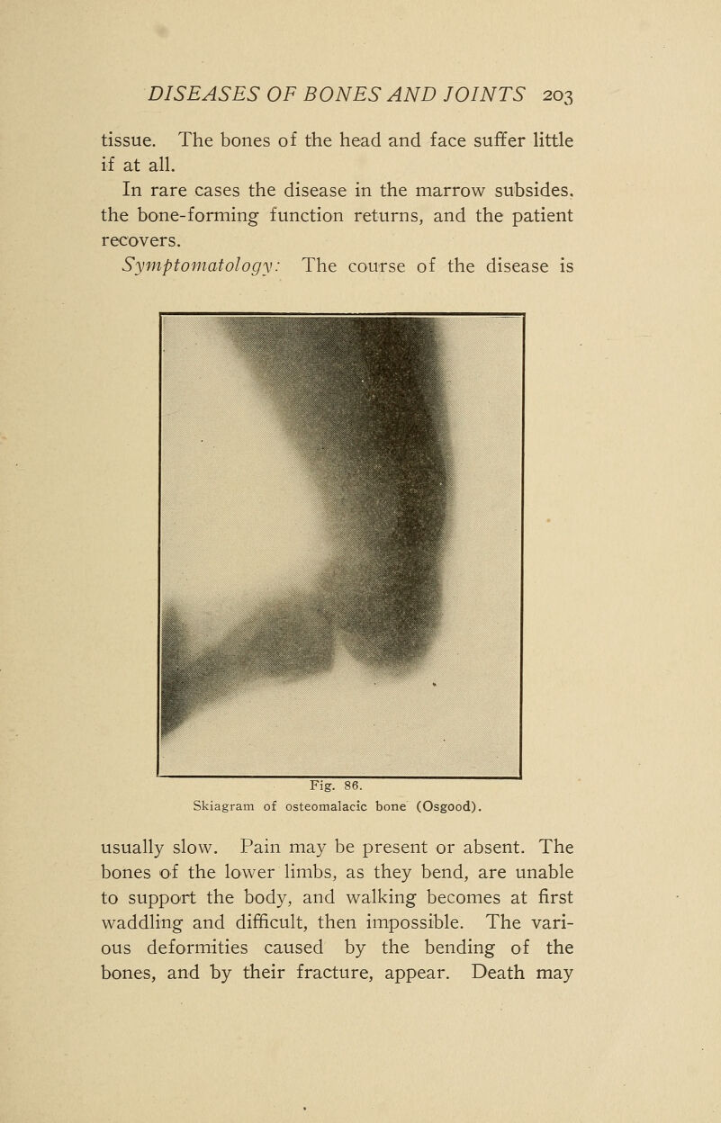 tissue. The bones of the head and face suffer little if at all. In rare cases the disease in the marrow subsides, the bone-forming function returns, and the patient recovers. Symptomatology: The course of the disease is Fig. 86. Skiagram of osteomalacic bone (Osgood). usually slow. Pain may be present or absent. The bones of the lower limbs, as they bend, are unable to support the body, and walking becomes at first waddling and difficult, then impossible. The vari- ous deformities caused by the bending of the bones, and by their fracture, appear. Death may