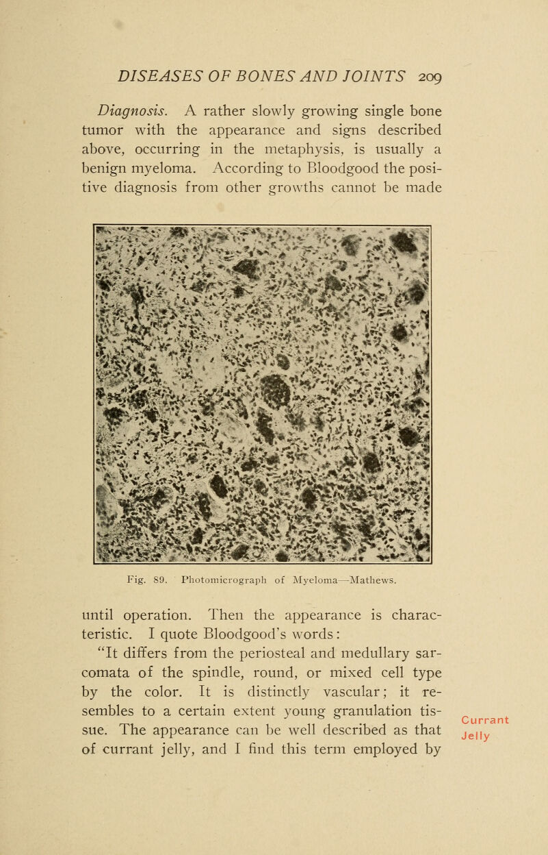 Diagnosis. A rather slowly growing single bone tumor with the appearance and signs described above, occurring in the metaphysis, is usually a benign myeloma. According to Bloodgood the posi- tive diagnosis from other growths cannot be made Fig. 89. Photomicrograph of Myeloma—Mathews. until operation. Then the appearance is charac- teristic. I quote Bloodgood's words: It differs from the periosteal and medullary sar- comata of the spindle, round, or mixed cell type by the color. It is distinctly vascular; it re- sembles to a certain extent young granulation tis- sue. The appearance can be well described as that of currant jelly, and I find this term employed by Currant Jelly