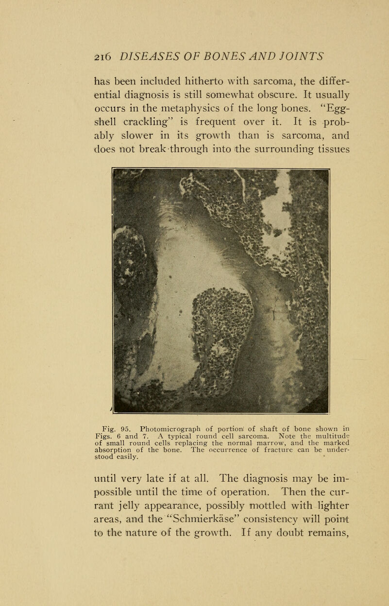 has been included hitherto with sarcoma, the differ- ential diagnosis is still somewhat obscure. It usually occurs in the metaphysics of the long bones. ''Egg- shell crackling is frequent over it. It is prob- ably slower in its growth than is sarcoma, and does not break through into the surrounding tissues Fig. 95. Photomicrograph of portion! of shaft of bone shown in Figs. 6 and 7. A typical round cell sarcoma. Note the multitude of small round cells replacing the normal marrow, and the marked absorption of the bone. The occurrence of fracture can be under- stood easily. until very late if at all. The diagnosis may be im- possible until the time of operation. Then the cur- rant jelly appearance, possibly mottled with lighter areas, and theSchmierkase consistency will point to the nature of the growth. If any doubt remains,