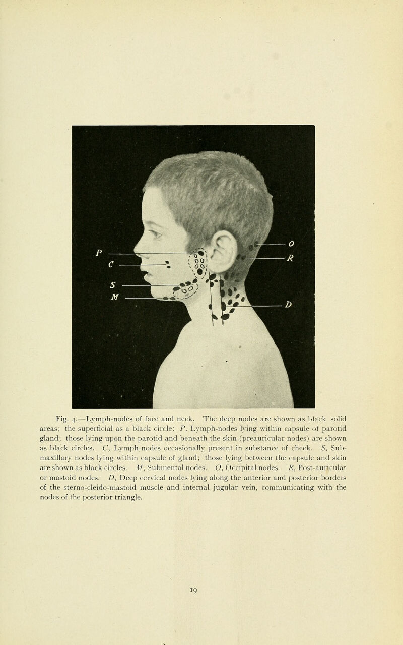 Fig. 4.—Lymph-nodes of face and neck. The deep nodes are shown as black solid areas; the superficial as a black circle: P, Lymph-nodes lying within capsule of parotid gland; those lying upon the parotid and beneath the skin (preauricular nodes) are shown as black circles. C, Lymph-nodes occasionally present in substance of cheek. S, Sub- maxillary nodes lying within capsule of gland; those lving between the capsule and skin are shown as black circles. M, Submental nodes. O, Occipital nodes. R, Post-auricular or mastoid nodes. D, Deep cervical nodes lying along the anterior and posterior borders of the sterno-cleido-mastoid muscle and internal jugular vein, communicating with the nodes of the posterior triangle.