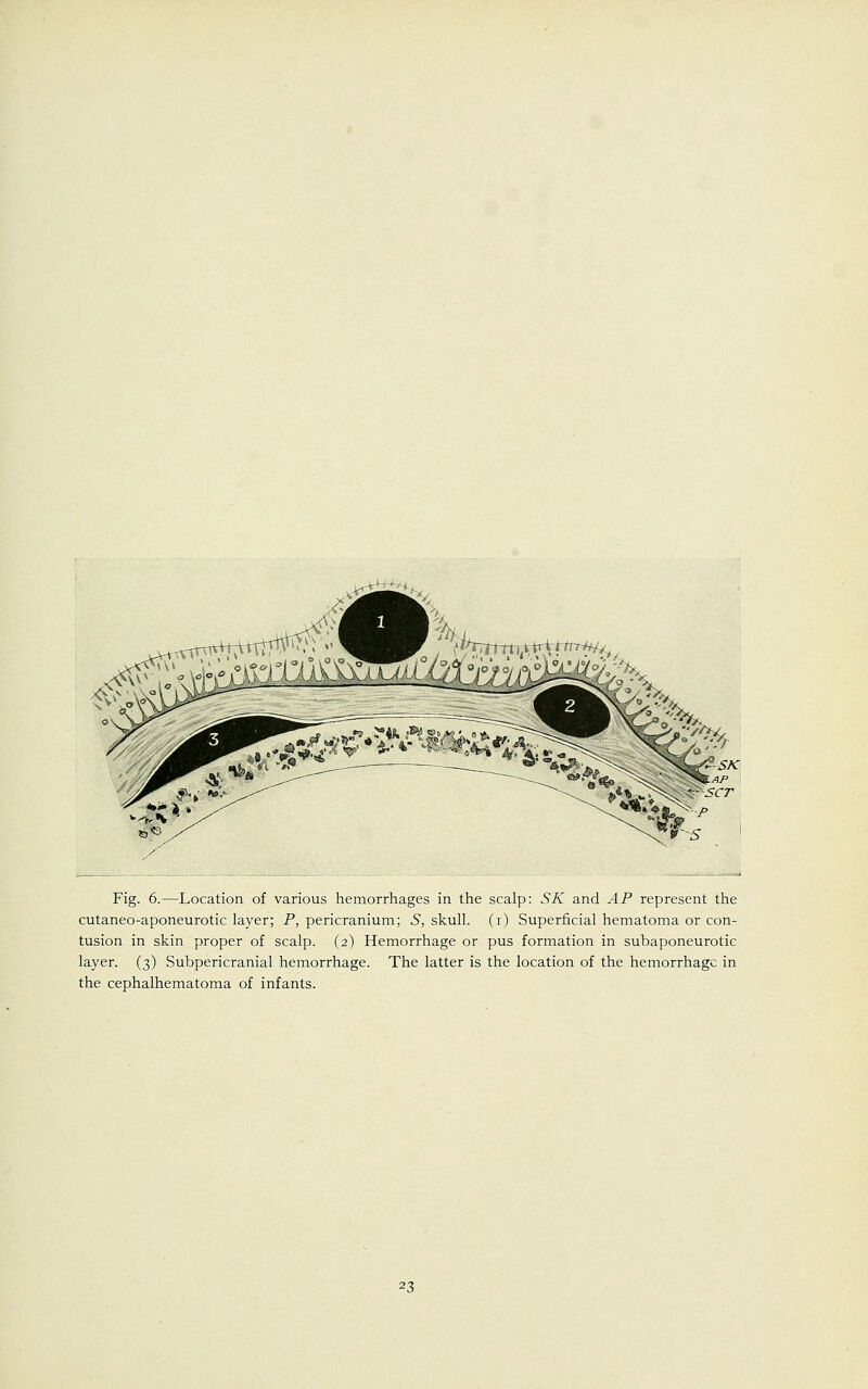 ^, ^:i ^B W * tlfT7ttmtt,lrttitrHfy UTS Fig. 6.—Location of various hemorrhages in the scalp: SK and AP represent the cutaneo-aponeurotic layer; P, pericranium; S, skull, (i) Superficial hematoma or con- tusion in skin proper of scalp. (2) Hemorrhage or pus formation in subaponeurotic layer. (3) Subpericranial hemorrhage. The latter is the location of the hemorrhage in the cephalhematoma of infants.