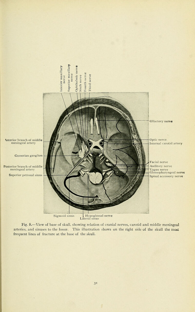 Interior branch of middle meningeal artery Gasserian ganglion Posterior branch of middle meningeal artery Superior petrosal sinus Olfactory nerve Optic nerve Internal carotid artery Facial nerve Auditory nerve Vagus nerve Glossopharyngeal nerve Spinal accessory nerve Sigmoid sinus Hypoglossal nerve Lateral sinus Fig. 8.—View of base of skull, showing relation of cranial nerves, carotid and middle meningeal arteries, and sinuses to the fossae. This illustration shows on the right side of the skull the most frequent lines of fracture at the base of the skull.