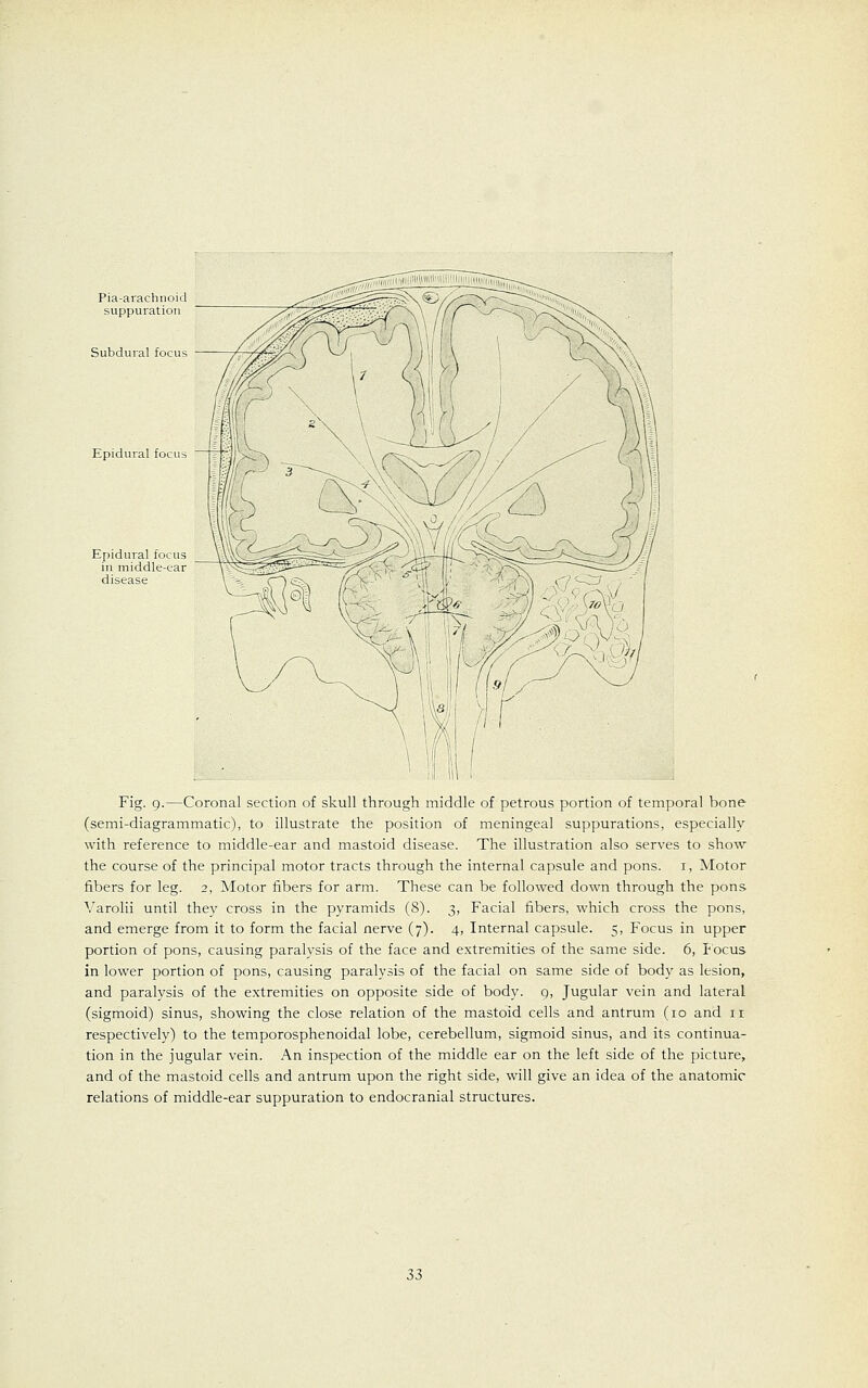 Pia-arachnoii suppuration Subdural focus Epidural focu Epidural focus in middle-ear disease Fig. 9.—Coronal section of skull through middle of petrous portion of temporal bone (semi-diagrammatic), to illustrate the position of meningeal suppurations, especially with reference to middle-ear and mastoid disease. The illustration also serves to show the course of the principal motor tracts through the internal capsule and pons. 1, Motor fibers for leg. 2, Motor fibers for arm. These can be followed down through the pons Varolii until they cross in the pyramids (8). 3, Facial fibers, which cross the pons, and emerge from it to form the facial nerve (7). 4, Internal capsule. 5, Focus in upper portion of pons, causing paralysis of the face and extremities of the same side. 6, Focus in lower portion of pons, causing paralysis of the facial on same side of body as lesion, and paralysis of the extremities on opposite side of body. 9, Jugular vein and lateral (sigmoid) sinus, showing the close relation of the mastoid cells and antrum (10 and 11 respectively) to the temporosphenoidal lobe, cerebellum, sigmoid sinus, and its continua- tion in the jugular vein. An inspection of the middle ear on the left side of the picture, and of the mastoid cells and antrum upon the right side, will give an idea of the anatomic relations of middle-ear suppuration to endocranial structures.