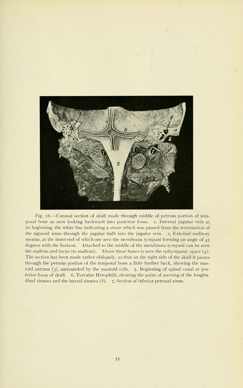 Fig. 16.—Coronal section of skull made through middle of petrous portion of tem- poral bone as seen looking backward into posterior fossa, i, Internal jugular vein at its beginning, the white line indicating a straw which was passed from the termination of the sigmoid sinus through the jugular bulb into the jugular vein. 2, External auditory meatus, at the inner end of which one sees the membrana tympani forming an angle of 45 degrees with the horizon. Attached to the middle of the membrana tympani can be seen the malleus and incus (to malleus). Above these bones is seen the epitympanic space (4). The section has been made rather obliquely, so that on the right side of the skull it passes through the petrous portion of the temporal bone a little further back, showing the mas- toid antrum (3), surrounded by the mastoid cells. 5, Beginning of spinal canal at pos- terior fossa of skull. 6, Torcular Herophilii, showing the point of meeting of the longitu- dinal sinuses and the lateral sinuses (8). 7, Section of inferior petrosal sinus.