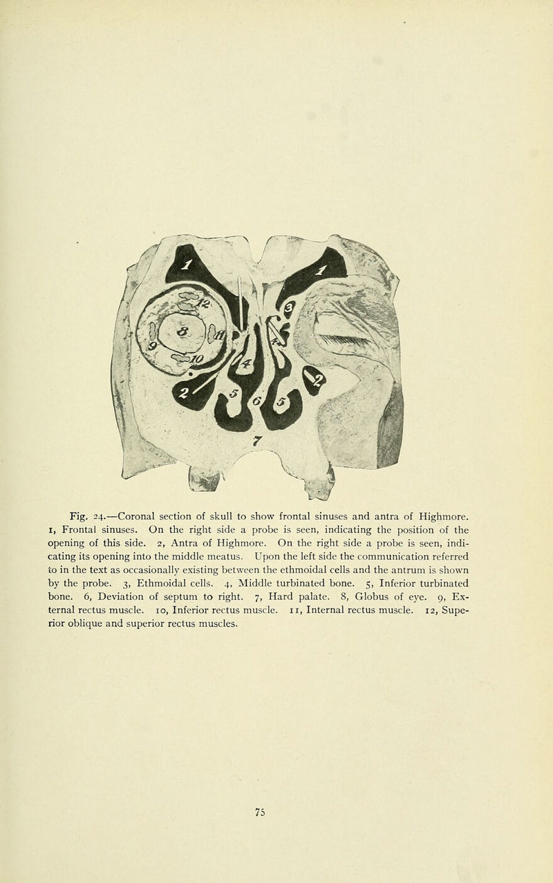 Fig. 24.—Coronal section of skull to show frontal sinuses and antra of Highmore. I, Frontal sinuses. On the right side a probe is seen, indicating the position of the opening of this side. 2, Antra of Highmore. On the right side a probe is seen, indi- cating its opening into the middle meatus. Upon the left side the communication referred to in the text as occasionally existing between the ethmoidal cells and the antrum is shown by the probe. 3, Ethmoidal cells. 4, Middle turbinated bone. 5, Inferior turbinated bone. 6, Deviation of septum to right. 7, Hard palate. 8, Globus of eye. 9, Ex- ternal rectus muscle. 10, Inferior rectus muscle, n, Internal rectus muscle. 12, Supe- rior oblique and superior rectus muscles.