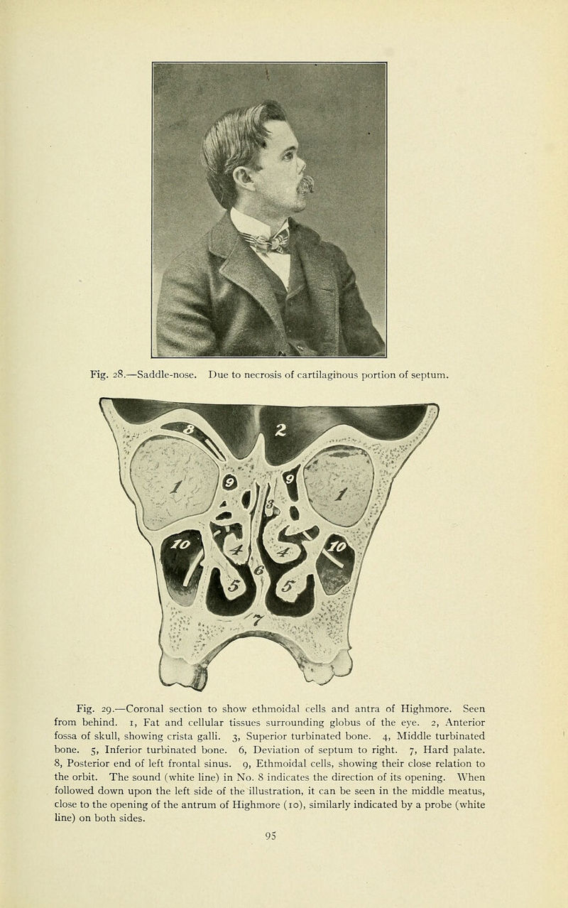 Fig. 28.—Saddle-nose. Due to necrosis of cartilaginous portion of septum. Fig. 29.—Coronal section to show ethmoidal cells and antra of Highmore. Seen from behind. 1, Fat and cellular tissues surrounding globus of the eye. 2, Anterior fossa of skull, showing crista galli. 3, Superior turbinated bone. 4, Middle turbinated bone. 5, Inferior turbinated bone. 6, Deviation of septum to right. 7, Hard palate. 8, Posterior end of left frontal sinus. 9, Ethmoidal cells, showing their close relation to the orbit. The sound (white line) in No. 8 indicates the direction of its opening. When followed down upon the left side of the illustration, it can be seen in the middle meatus, close to the opening of the antrum of Highmore (10), similarly indicated by a probe (white line) on both sides.