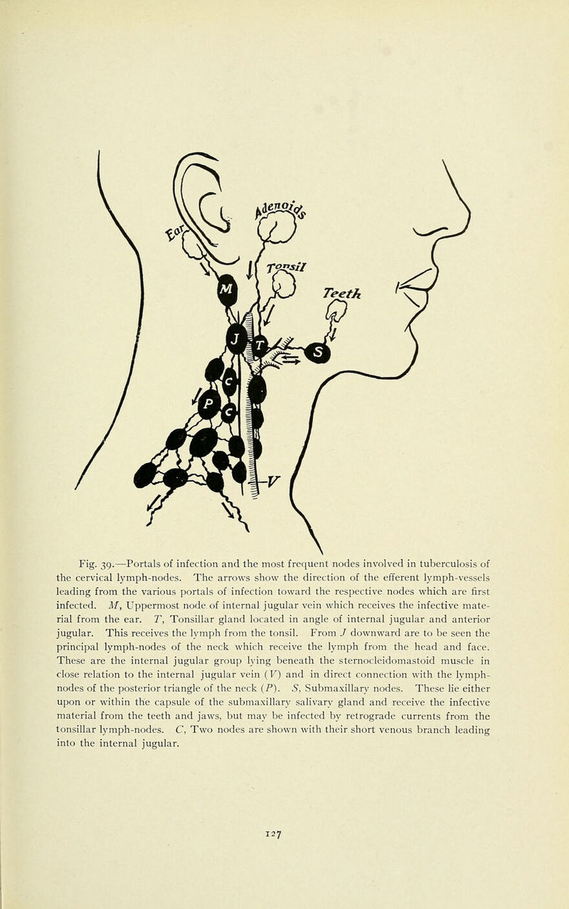 Fig. 39.—Portals of infection and the most frequent nodes involved in tuberculosis of the cervical lymph-nodes. The arrows show the direction of the efferent lymph-vessels leading from the various portals of infection toward the respective nodes which are first infected. M, Uppermost node of internal jugular vein which receives the infective mate- rial from the ear. T, Tonsillar gland located in angle of internal jugular and anterior jugular. This receives the lymph from the tonsil. From J downward are to be seen the principal lymph-nodes of the neck which receive the lymph from the head and face. These are the internal jugular group lying beneath the sternocleidomastoid muscle in close relation to the internal jugular vein (V) and in direct connection with the lymph- nodes of the posterior triangle of the neck (P). S, Submaxillary nodes. These lie either upon or within the capsule of the submaxillary salivary gland and receive the infective material from the teeth and jaws, but may be infected by retrograde currents from the tonsillar lymph-nodes. C, Two nodes are shown with their short venous branch leading into the internal jugular.