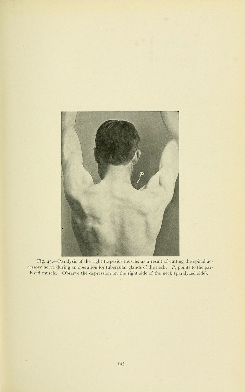 Fig. 45.—Paralysis of the right trapezius muscle, as a result of cutting the spinal ac- cessory nerve during an operation for tubercular glands of the neck. P, points to the par- alyzed muscle. Observe the depression on the right side of the neck (paralyzed side).