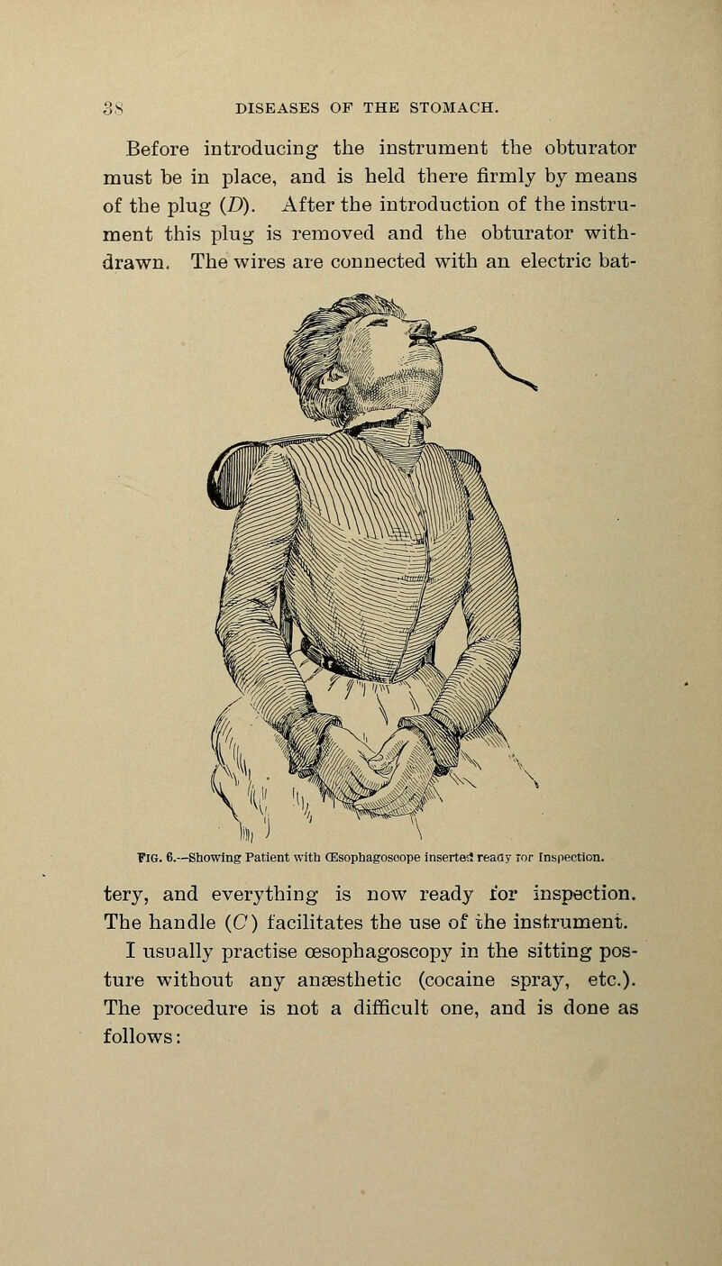 Before introducing the instrument the obturator must be in place, and is held there firmly by means of the plug (D). After the introduction of the instru- ment this plug is removed and the obturator with- drawn. The wires are connected with an electric bat- FlG. 6.—Showing Patient with CEsophagosoope inserted ready Tor Inspection. tery, and everything is now ready lor inspection. The handle (C) facilitates the use of the instrument. I usually practise cesophagoscopy in the sitting pos- ture without any anaesthetic (cocaine spray, etc.). The procedure is not a difficult one, and is done as follows: