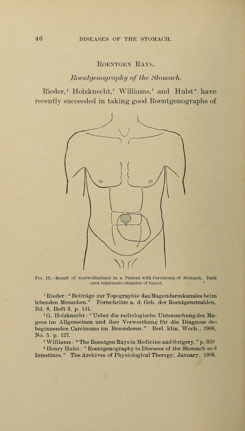 Eoentgen Kays. Roentgenography of the Stomach. Eieder,1 Holzknecht,2 Williams,3 and Hulst4 have recently succeeded in taking good Koentgenographs of Fig. 12.—Result of Gastrodiaphany in a Patient with Carcinoma of Stomach, area represents situation of tumor. Dark 1 Rieder : Beitrage zur Topographie desMagendarmkanales beim lebenden Menschen. Fortschritte a. d. Geb. der Roentgenstrahlen, Bd. 8, Heft 3, p. 141. 2G. Holzknecht: Ueber die radiologische Untersuchungdes Ma- gens im Allgemeinen und ihre Verwerthung fiir die Diagnose des beginnenden Carcinoms im Besonderen. Berl. klin. Woch., 1906, No. 5, p. 127. 3 Williams : The Roentgen Rays in Medicine and Surgery, p. 350 4 Henry Hulst: Roentgenography in Diseases of the Stomach ar,d Intestines. The Archives of Physiological Therapy, January, 1906.