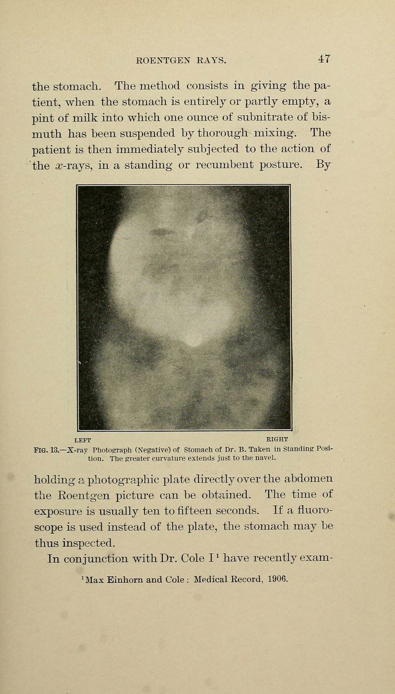 EOENTGEN RAYS. 4/T the stomach. The method consists in giving the pa- tient, when the stomach is entirely or partly empty, a pint of milk into which one ounce of subnitrate of bis- muth has been suspended by thorough mixing. The patient is then immediately subjected to the action of the x-rays, in a standing or recumbent posture. By LEFT RIGHT FIG. 13.—X-ray Photograph (Negative) of Stomach of Dr. B. Taken in Standing Posi- tion. The greater curvature extends just to the navel. holding a photographic plate directly over the abdomen the Roentgen picture can be obtained. The time of exposure is usually ten to fifteen seconds. If a fluoro- scope is used instead of the plate, the stomach may be thus inspected. In conjunction with Dr. Cole I* have recently exam- *Max Einhorn and Cole ; Medical Record, 1906.