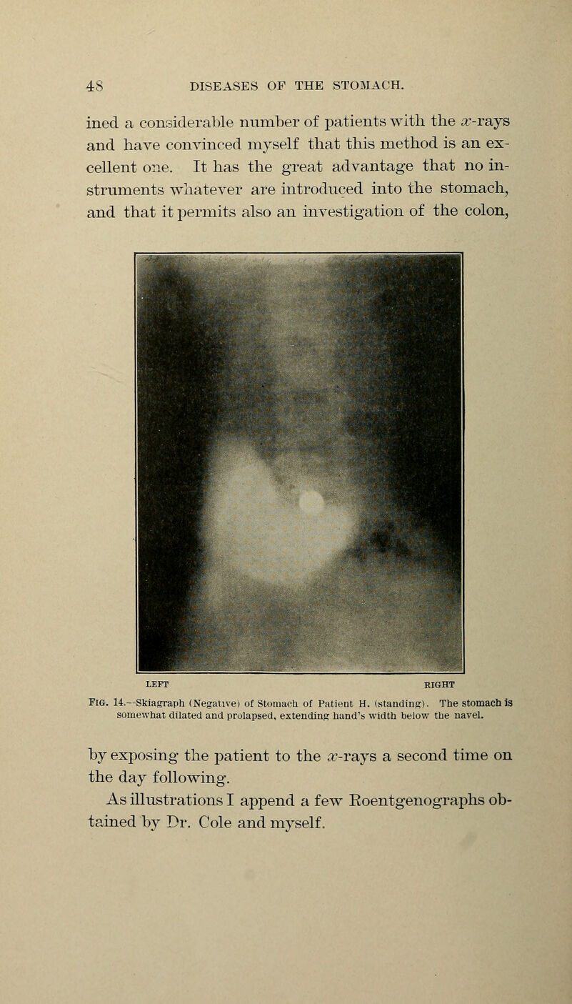 ined a considerable number of patients with the a'-rays and have convinced myself that this method is an ex- cellent one. It has the great advantage that no in- struments whatever are introduced into the stomach, and that it permits also an investigation of the colon, Tig. 14.—Skiagraph (Negative) of Stomach of Patient H. (standing). The stomach is somewhat dilated and prolapsed, extending hand's width below the navel. by exposing the patient to the #-rays a second time on the day following. As illustrations I append a few Roentgenographs ob- tained by Dr. Cole and myself.
