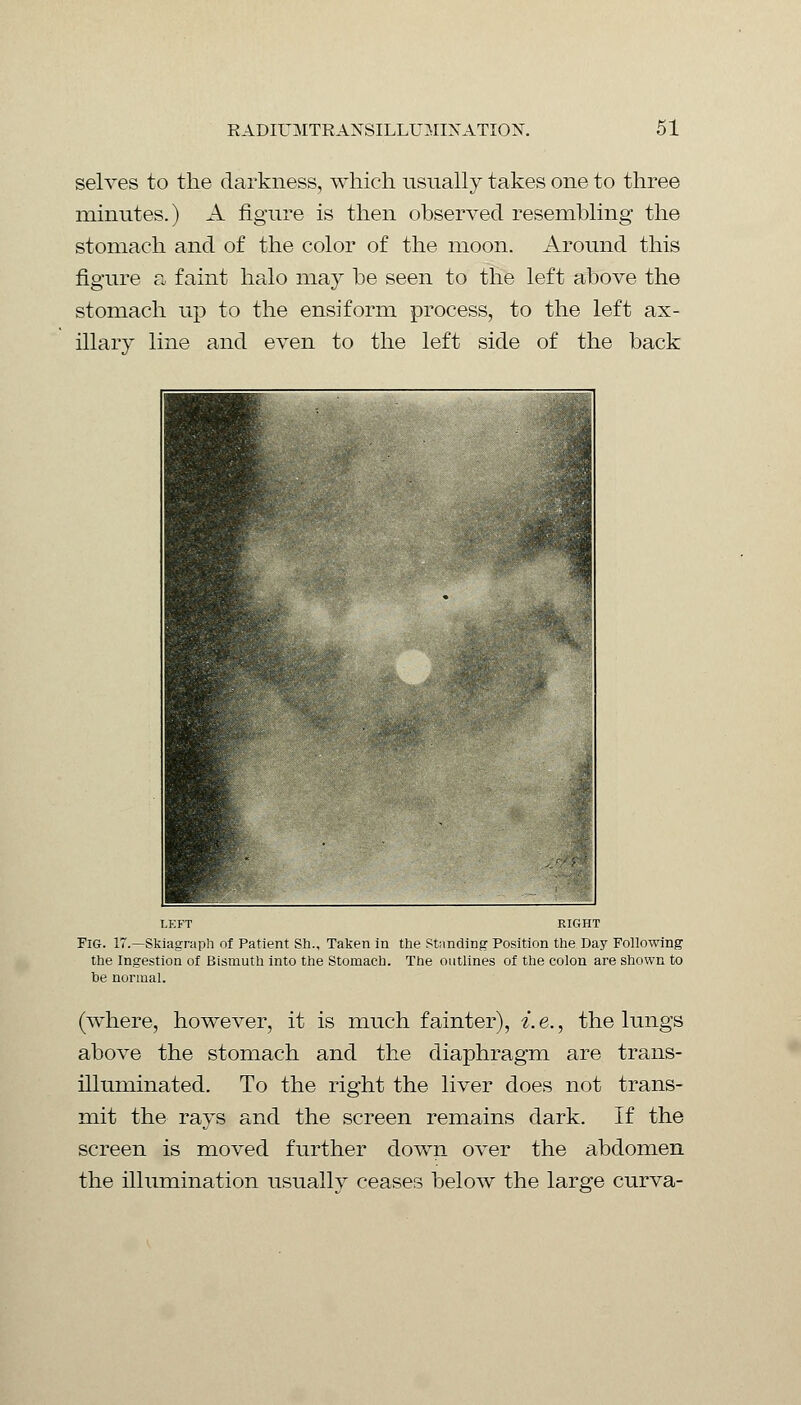 selves to the darkness, which usually takes one to three minutes.) A figure is then observed resembling the stomach and of the color of the moon. Around this figure a faint halo may be seen to the left above the stomach up to the ensiform process, to the left ax- illary line and even to the left side of the back LEFT RIGHT Fig. 17.—Skiagraph of Patient Sh., Taken in the Standing Position the Day Following the Ingestion of Bismuth into the Stomach. The outlines of the colon are shown to be normal. (where, however, it is much fainter), i.e., the lungs above the stomach and the diaphragm are trans- illuminated. To the right the liver does not trans- mit the rays and the screen remains dark. If the screen is moved further down over the abdomen the illumination usually ceases below the large curva-